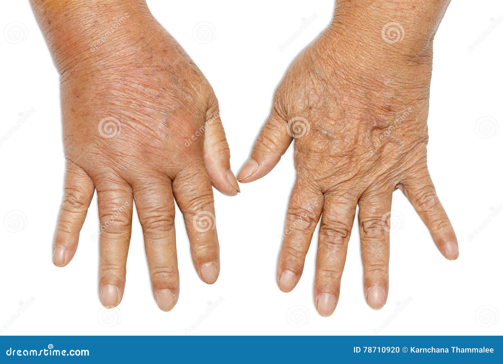 Manos Hinchadas De La Diabetes Foto de archivo Imagen de sangre