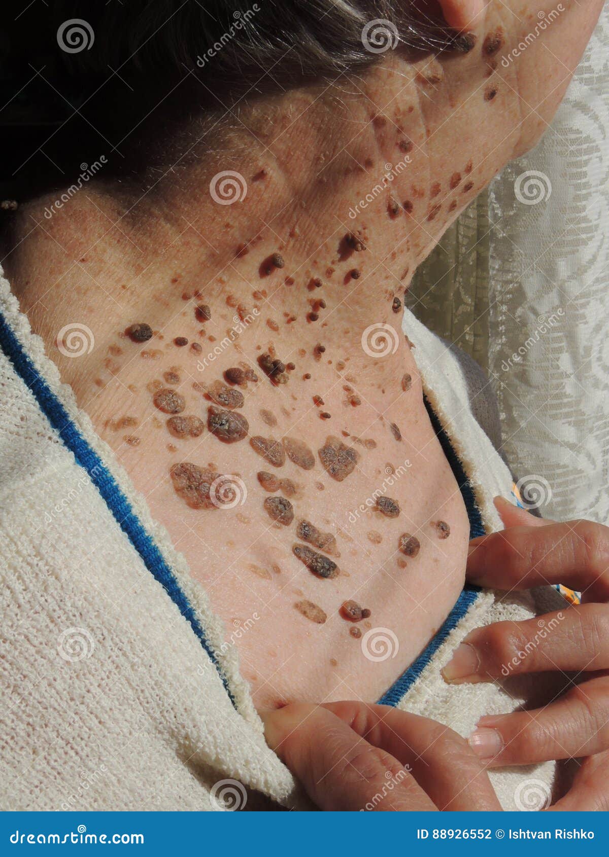 Birthmark Of Keratoma On The Skin Of An Old Mans Body Close up Royalty birthmark-of-keratoma-on-the-skin-of-an-old-mans-body-close-up-royalty