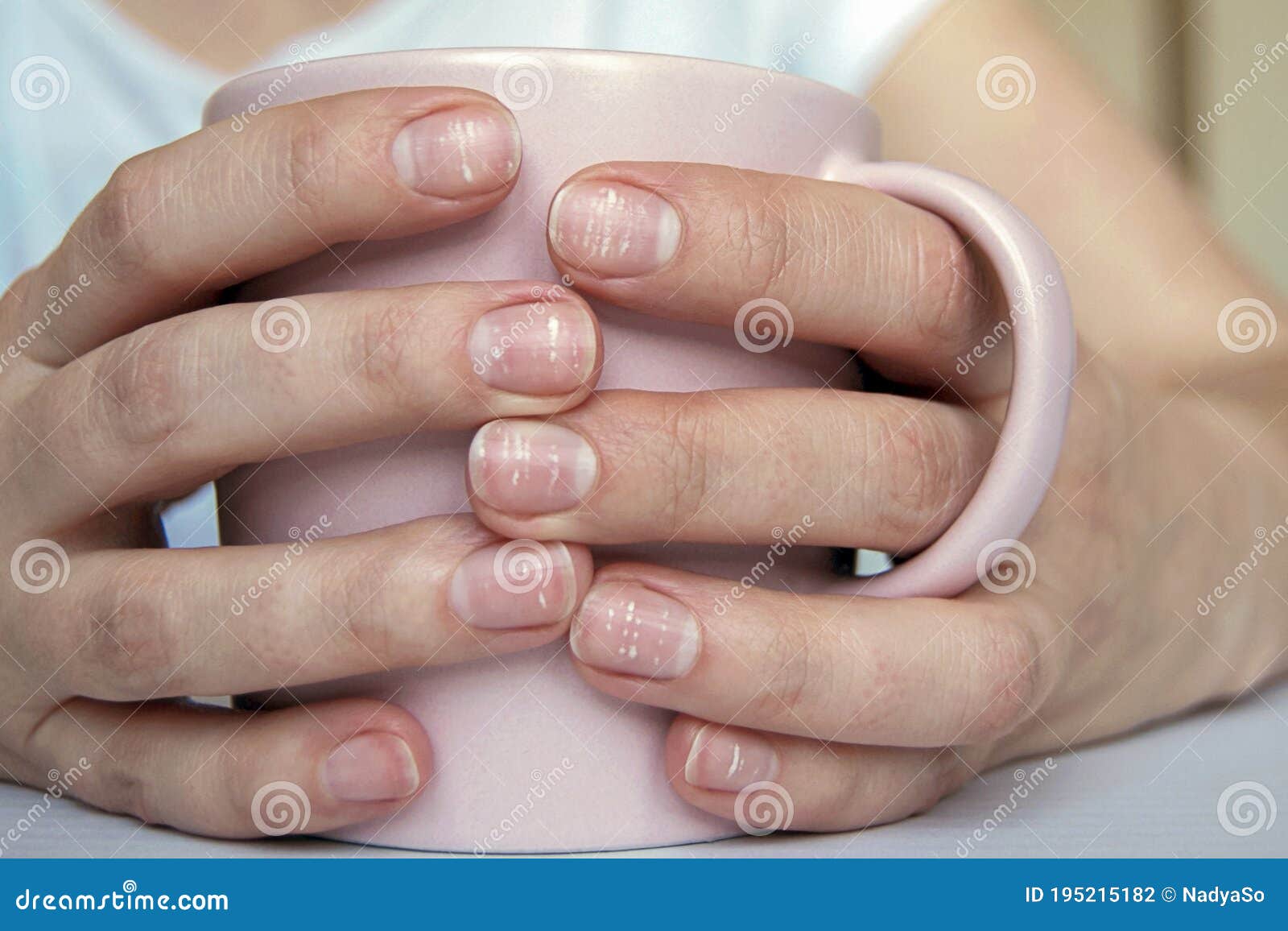 White Spots Nails Male Hand Caused Deficiency Calcium Zinc Poisoning Stock  Photo by ©AxOst 353643640