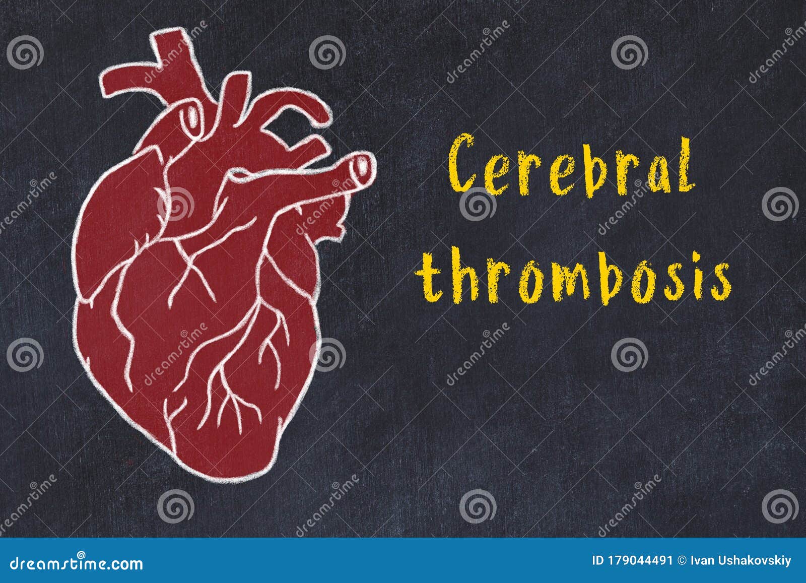 Marque El Boceto Con Tiza Del Corazon Humano En La Trombosis Cerebral Negra Del Desc Y La Inscripcion Stock De Ilustracion Ilustracion De Universidad Salud 179044491