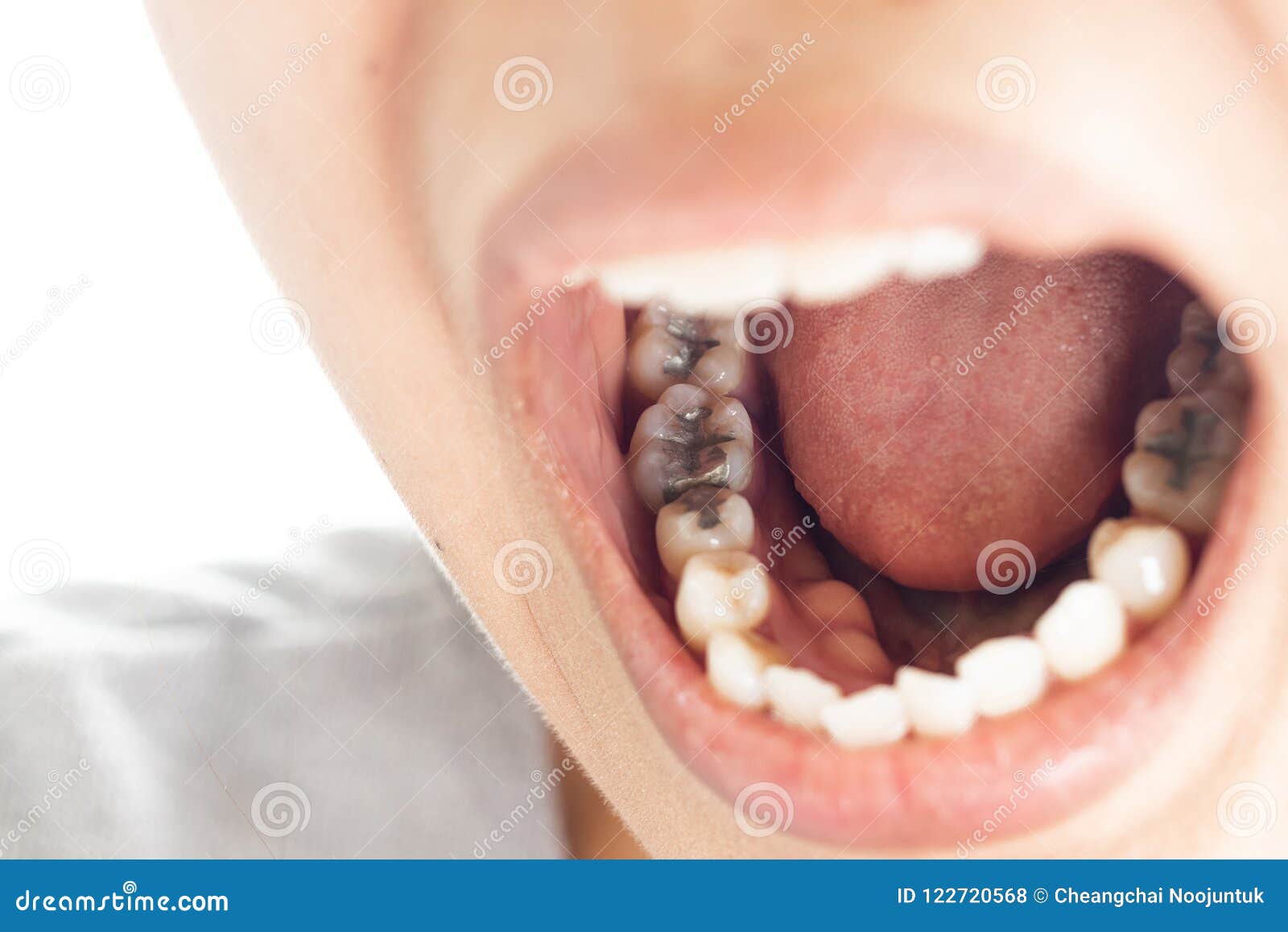 Otturazioni In Composito - Turismo Dentale| Aponia Dental & Aesthetic - Foto 12