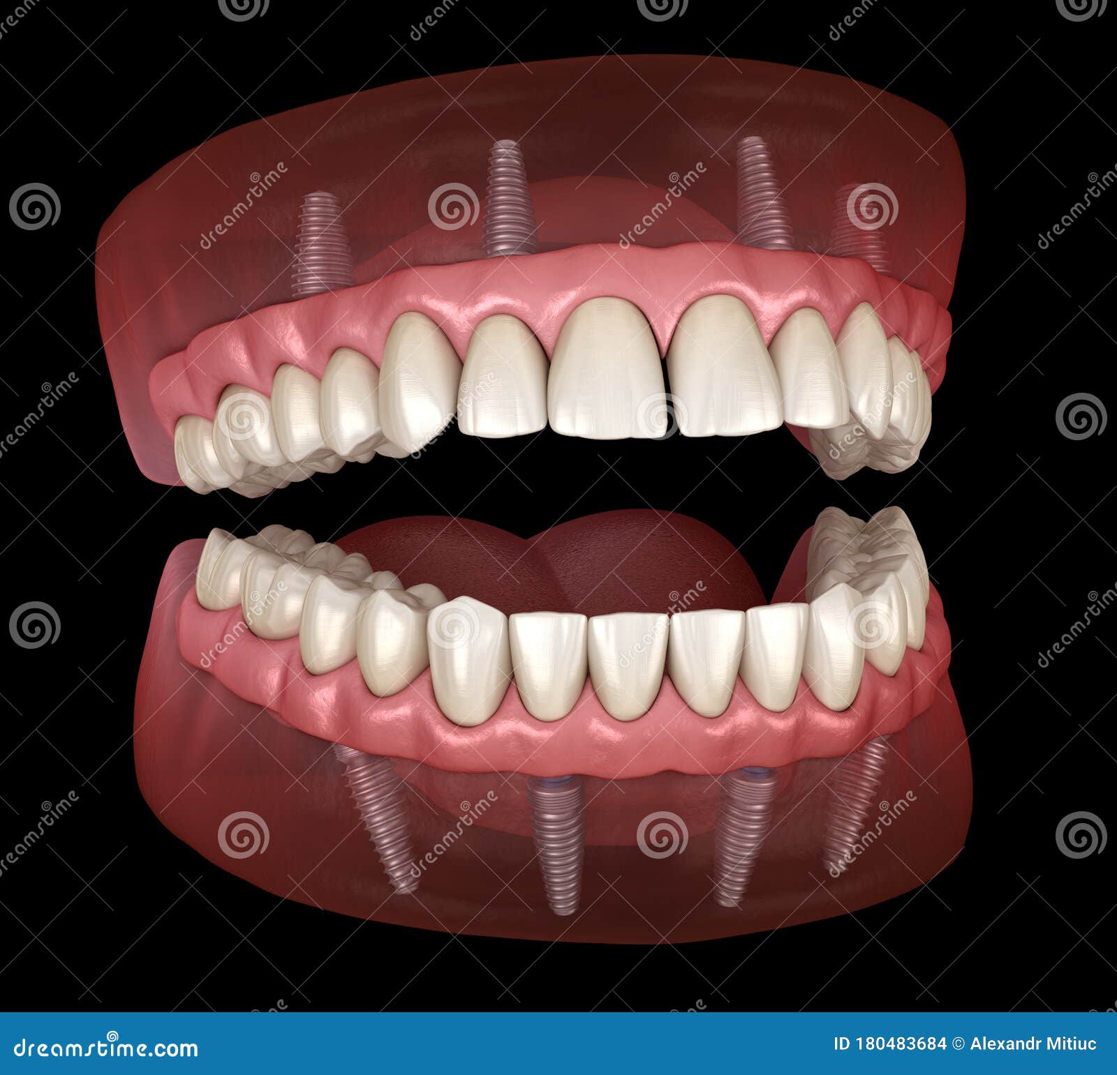 maxillary and mandibular prosthesis with gum all on 4 system supported by implants. medically accurate 3d 