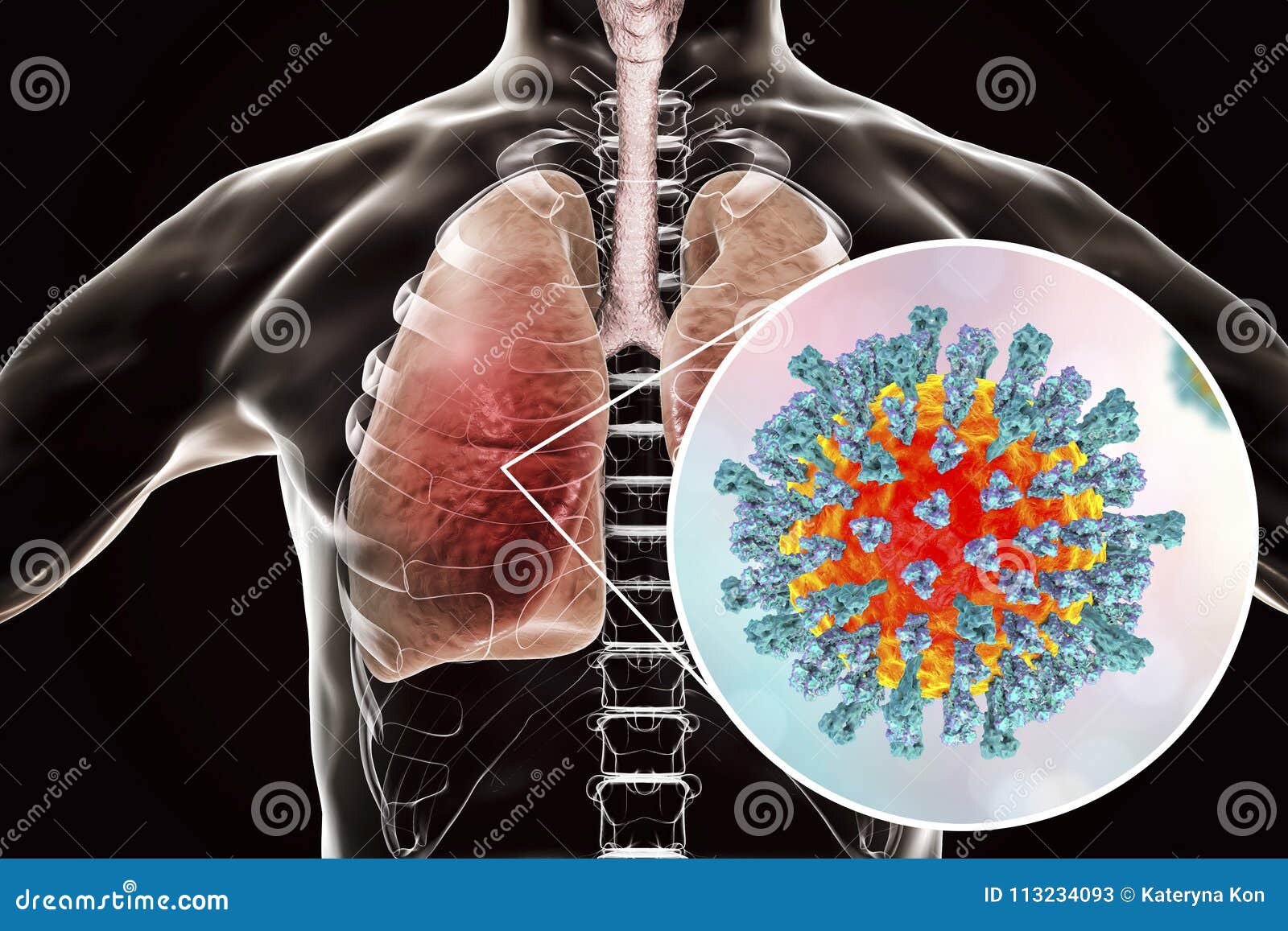 measles viruses in human respiratory system