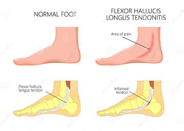 Medial Ankle Injury_Flexor Hallucis Tendonitis Stock Vector ...