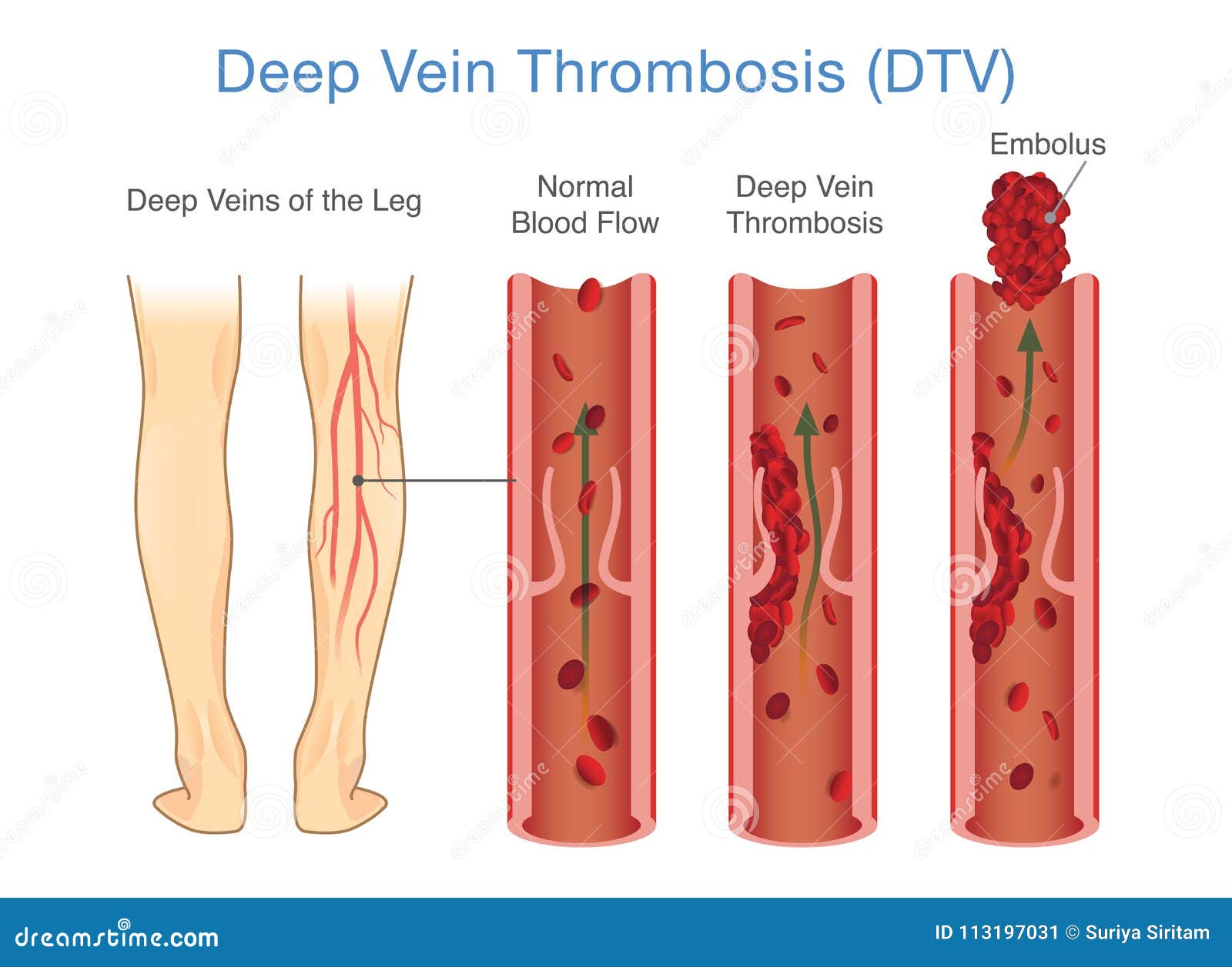 Deep Vein Thrombosis Anatomical Chart