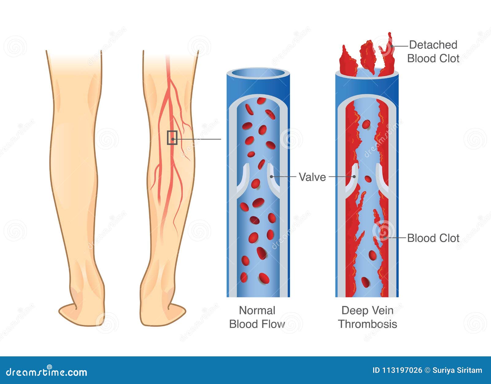 Deep Vein Thrombosis Anatomical Chart