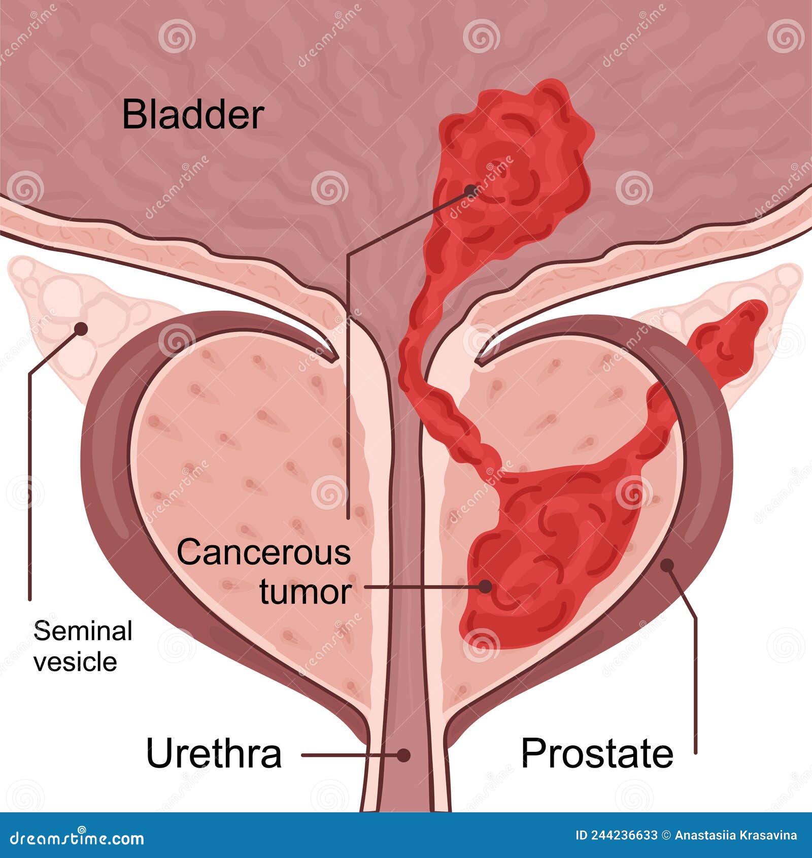 medical diagram of 4 stage of prostate cancer. tumor grows and penetrates into neighboring organs and tissues.