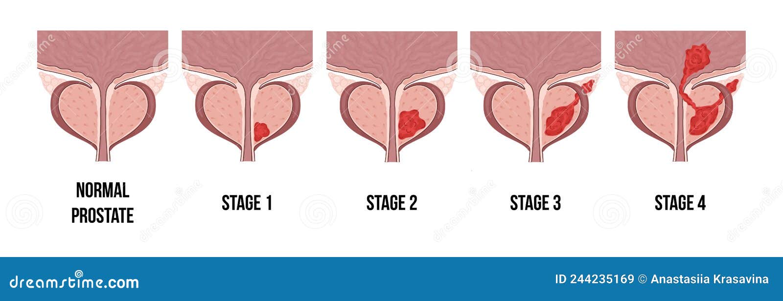 medical diagram of 4 stages of prostate cancer. tumor grows and penetrates into neighboring organs and tissues.