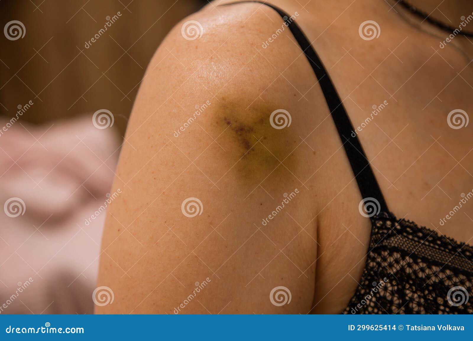 Medical Documentation Reveals a Woman with a Discreet Bruise on