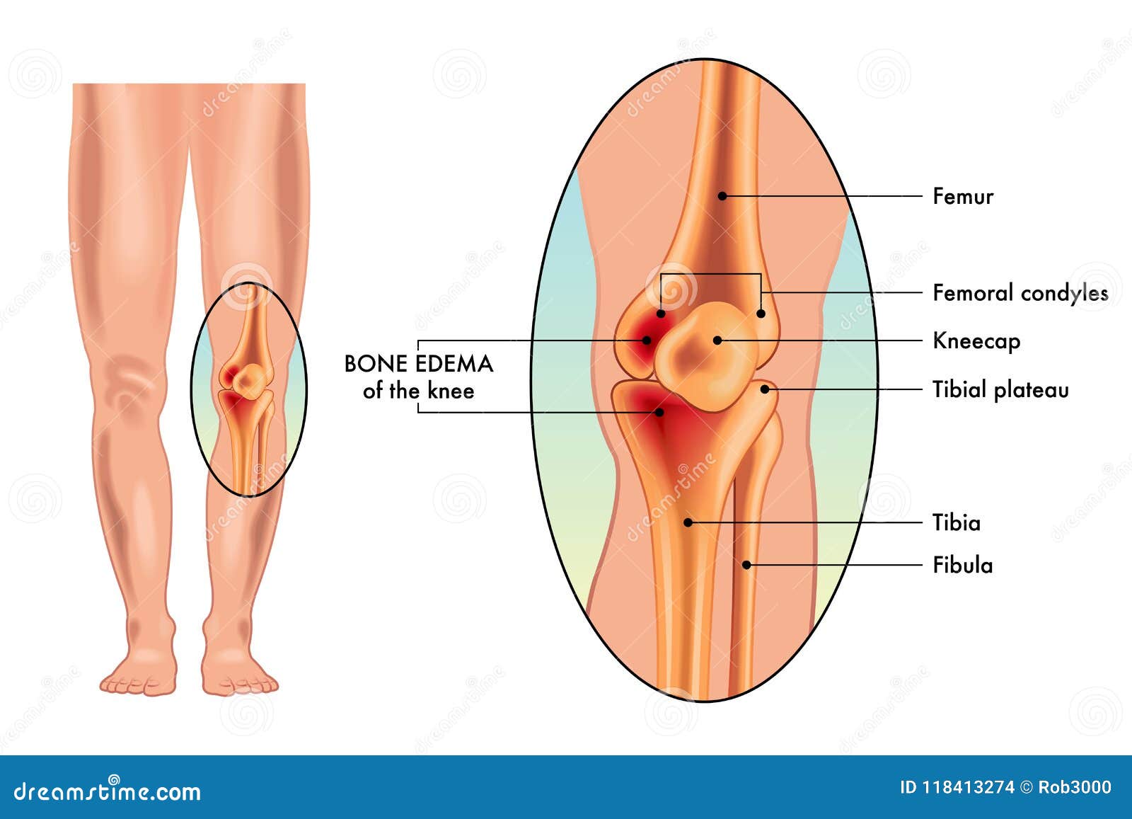medical  of bone edema on knee