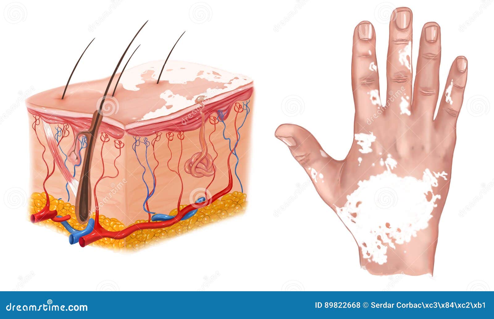 Medical Illustration of the Effects of Vitiligo Stock Illustration Illustration of neck, skin