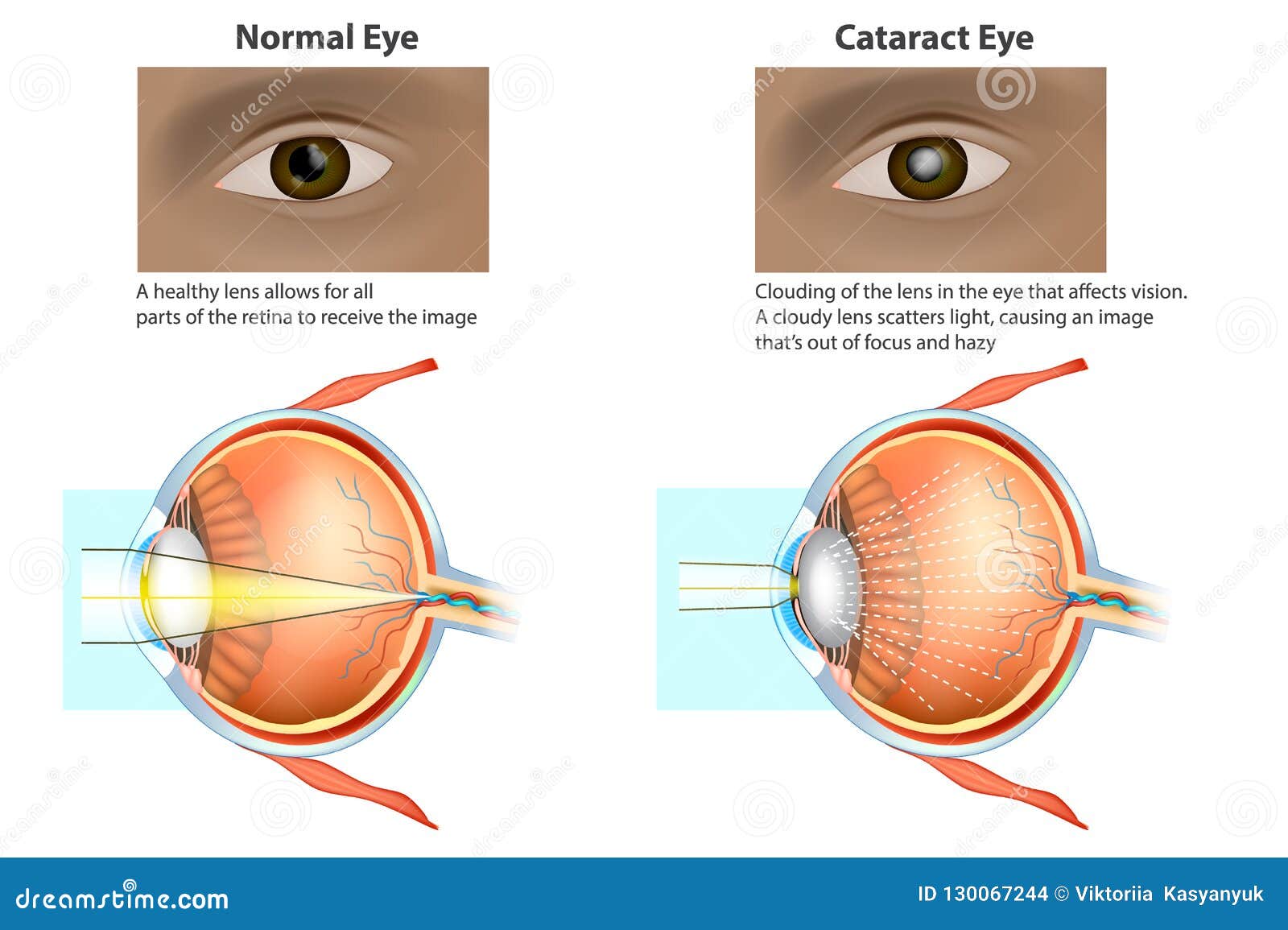 medical  of a normal eye and an eye with a cataract,