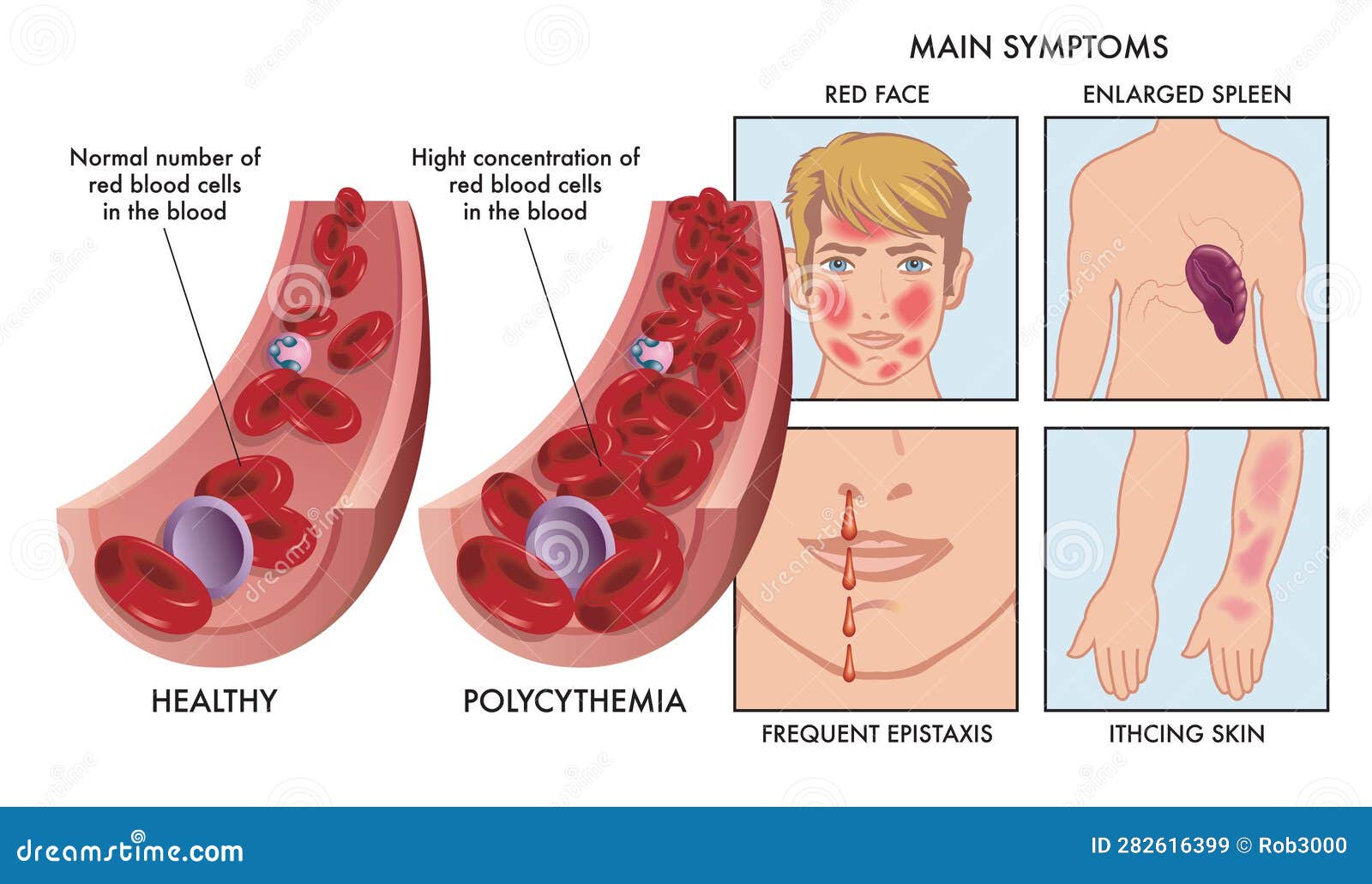 Polycythemia or Too Many Red Blood Cells