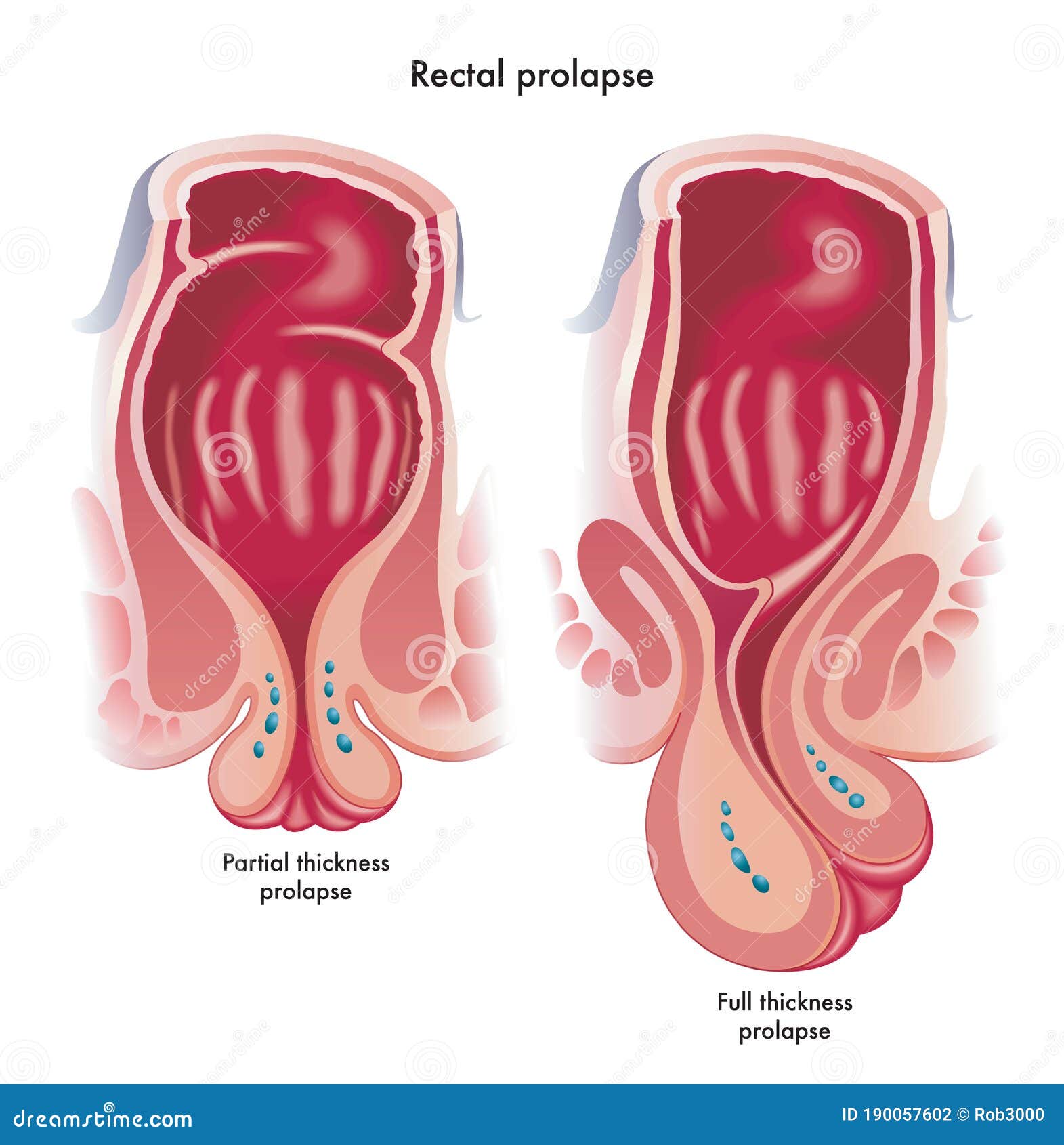 medical  showing two types of rectal prolapse