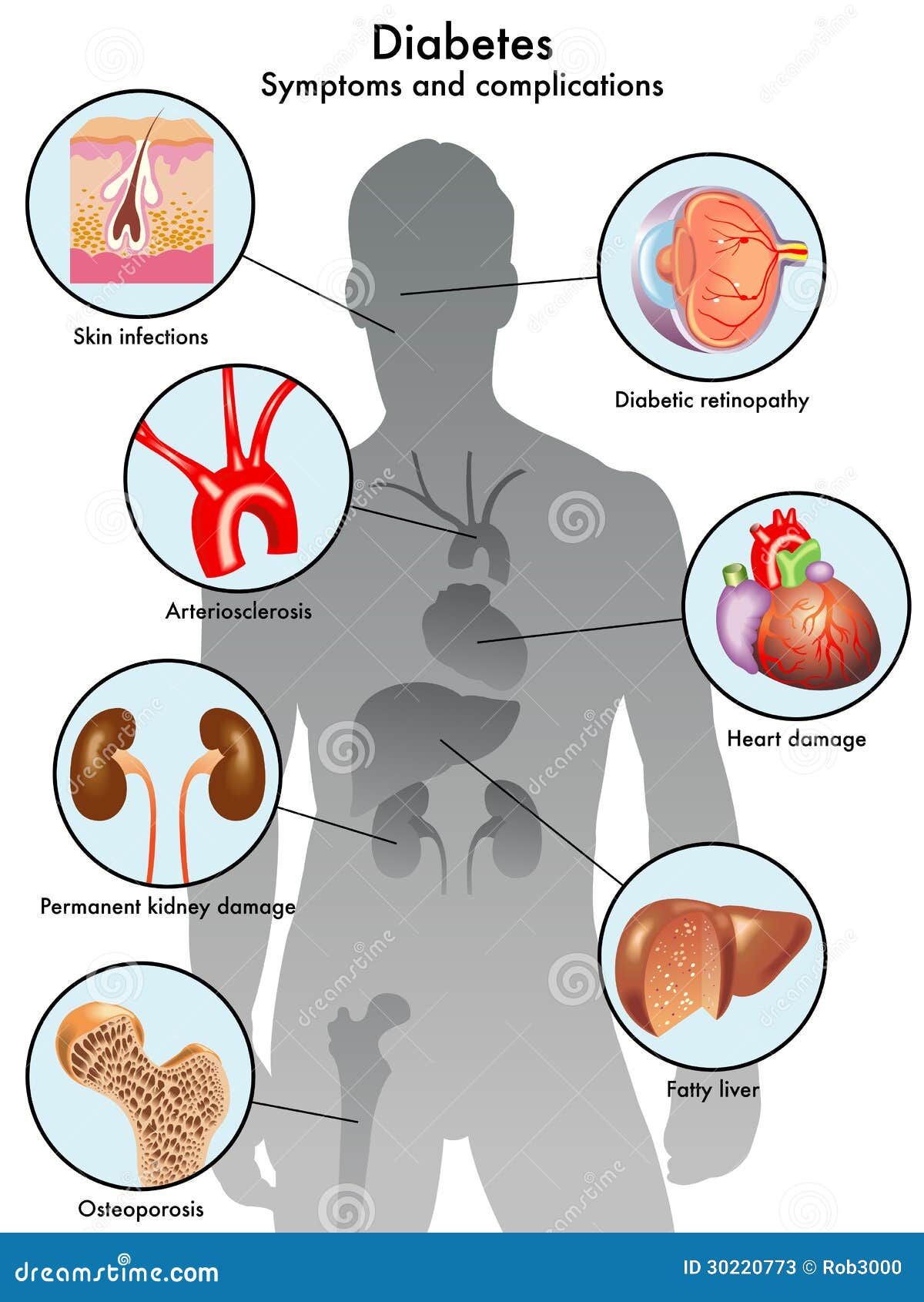 Diabetes (symptoms And Complications) Stock Photos - Image: 30220773