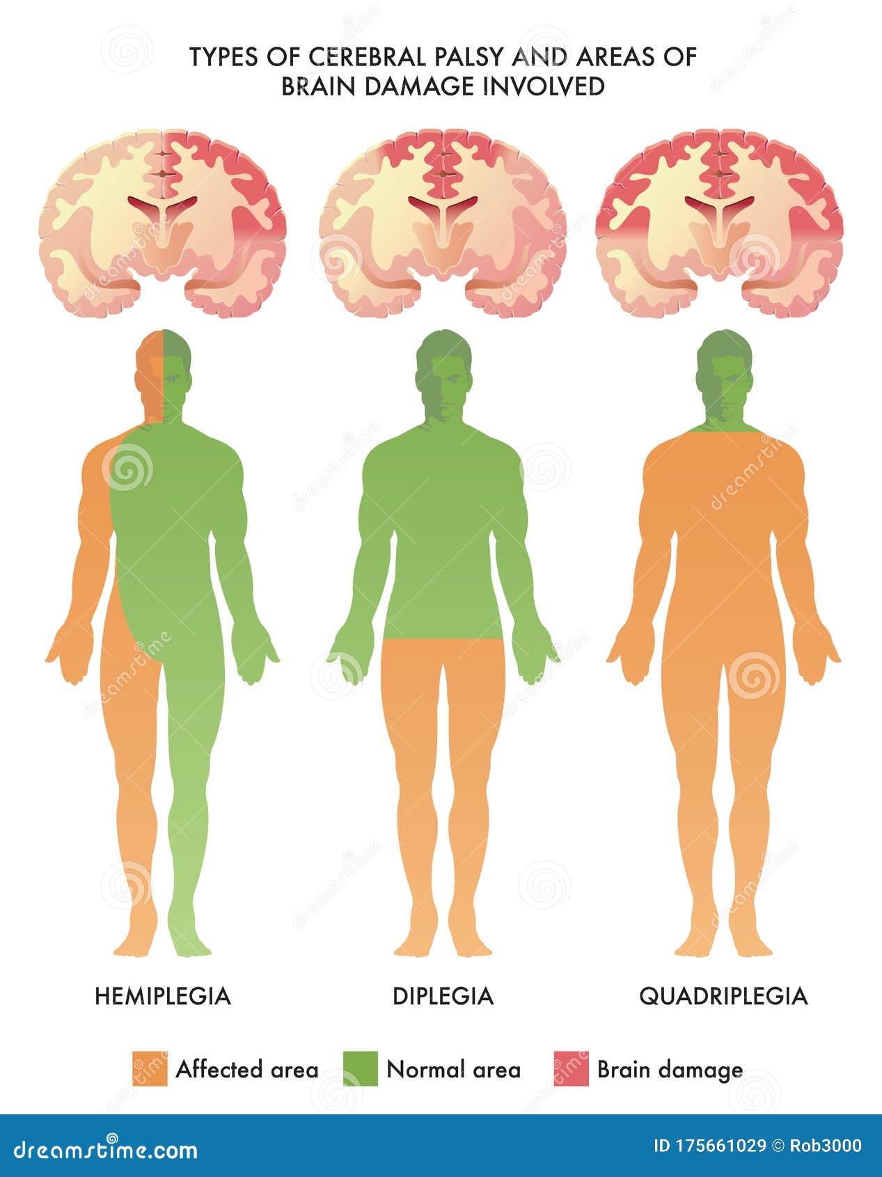 Medical Illustration Of Types Of Cerebral Palsy Stock Vector Illustration Of Healthcare Brain 175661029