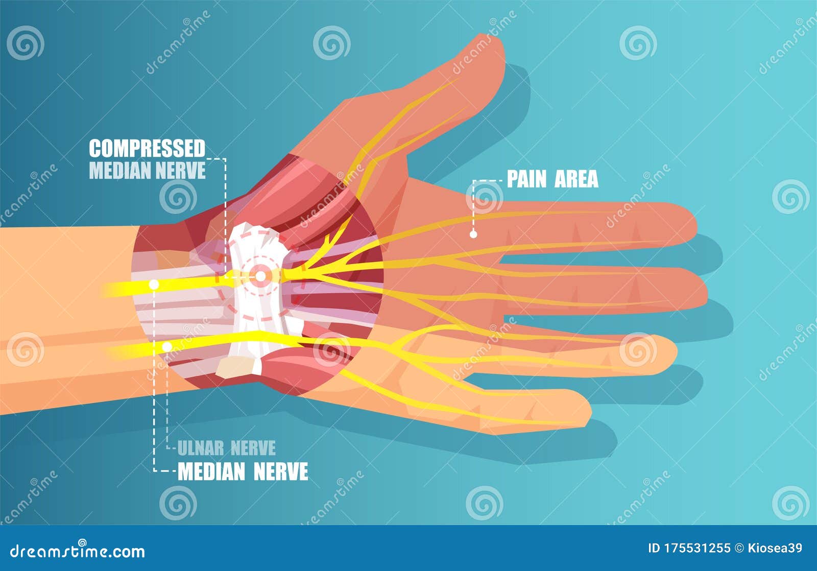  of a carpal tunnel syndrome with median nerve compression