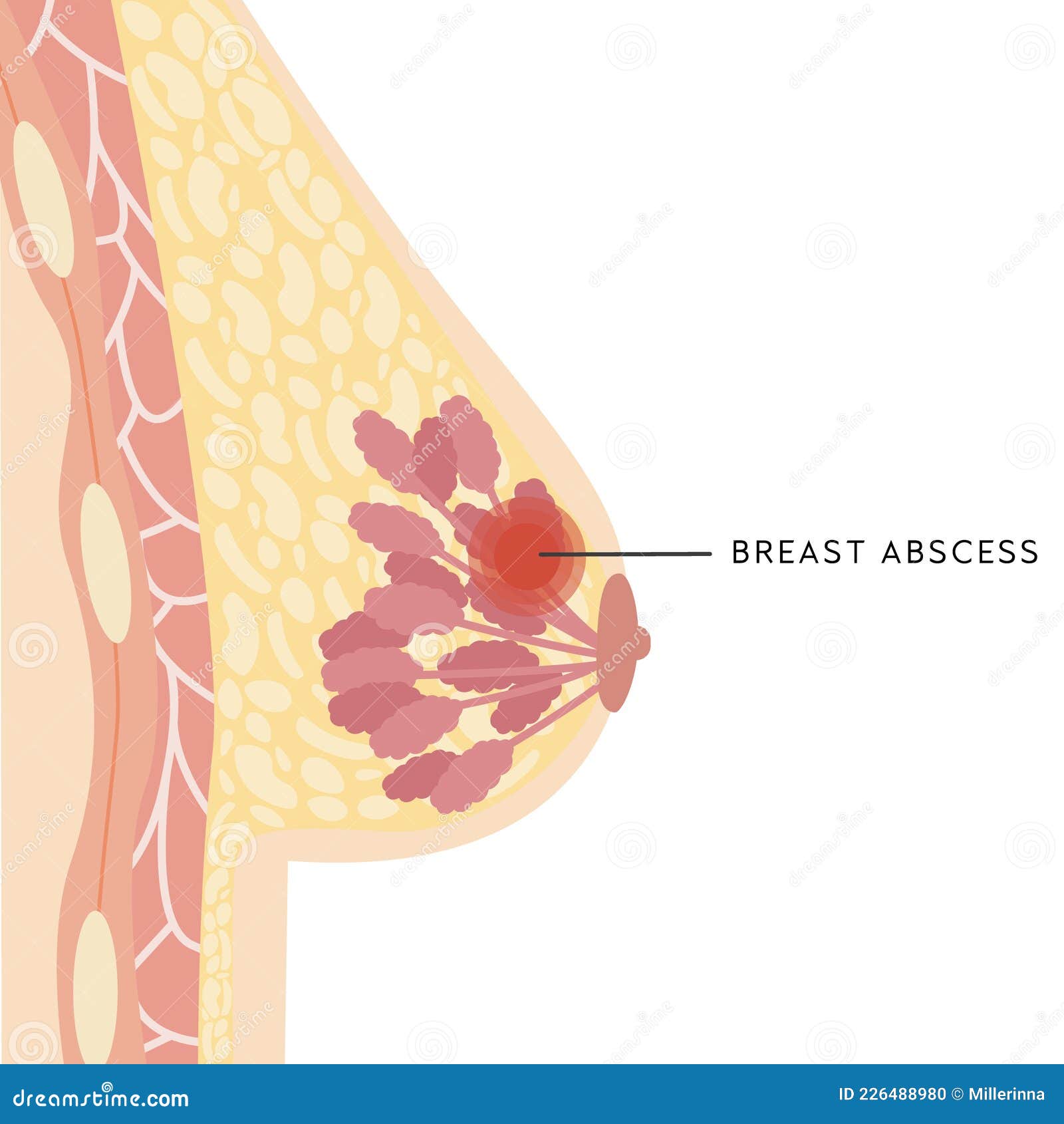 Breast abscess