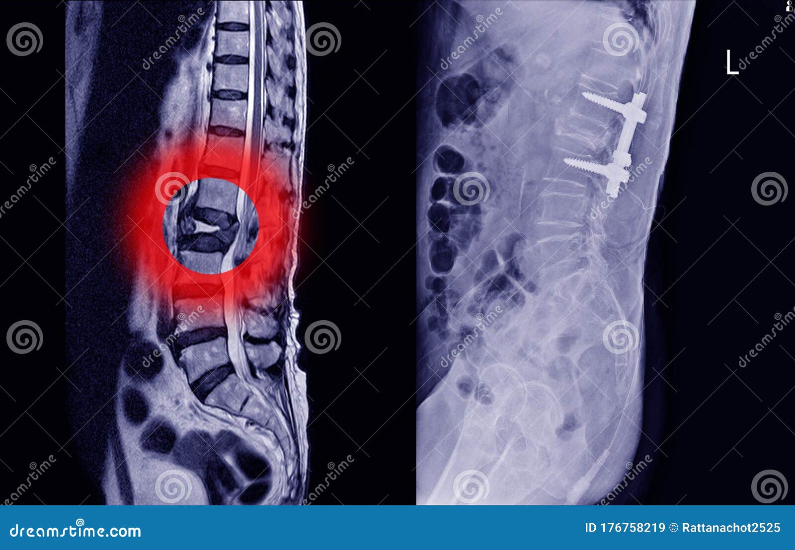 back bulging disk xray back bulging disk xray