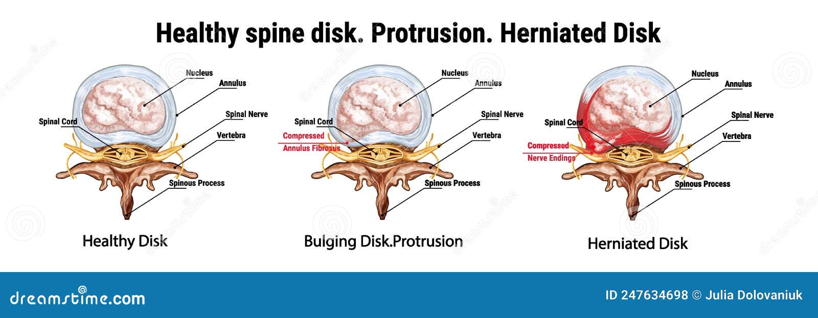 healthy spine disk. protrusion. herniated disk. bulging disk. the anatomical structure of the spine. compressed nerve endings.