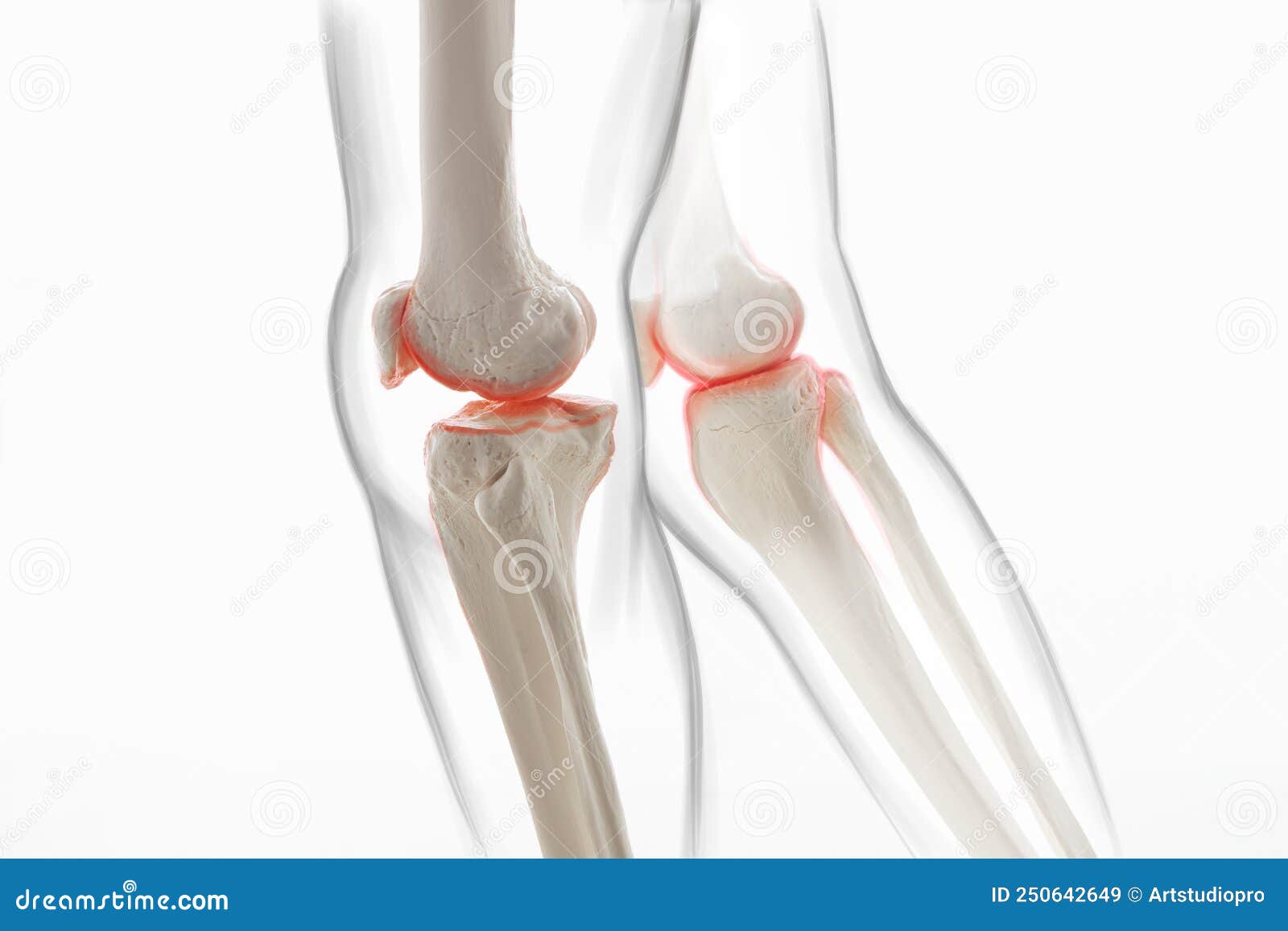 medically accurate representation of an arthritic knee joint, knee meniscus, human leg, 3d 