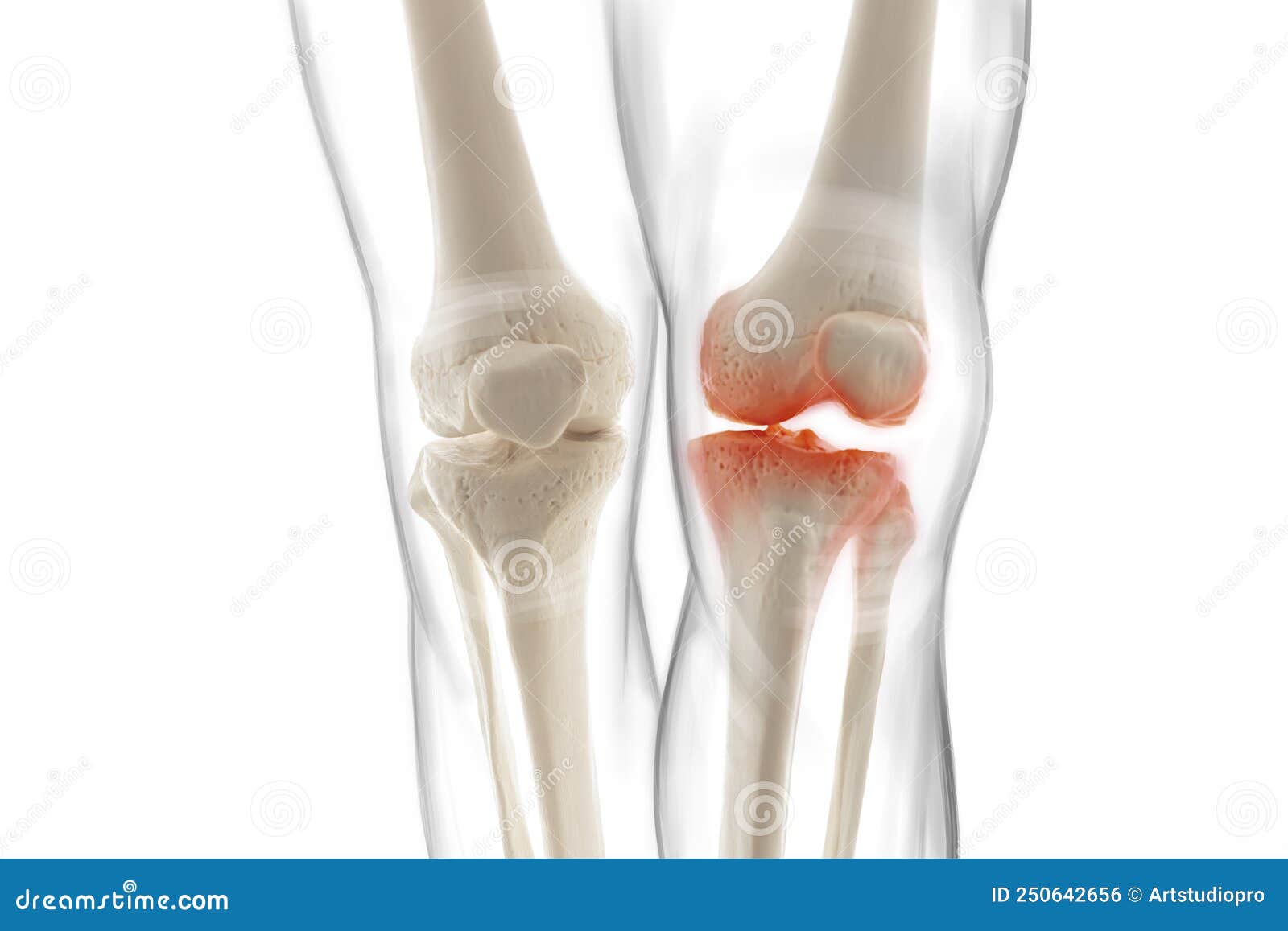 medically accurate representation of an arthritic knee joint, knee meniscus, human leg, 3d 