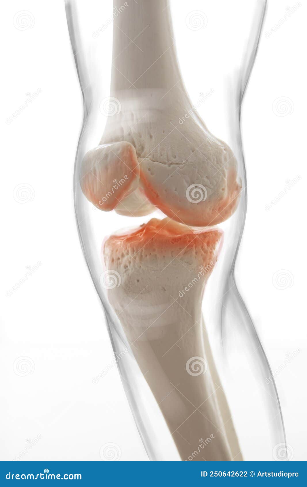 medically accurate representation of an arthritic knee joint, knee meniscus, human leg, 3d 