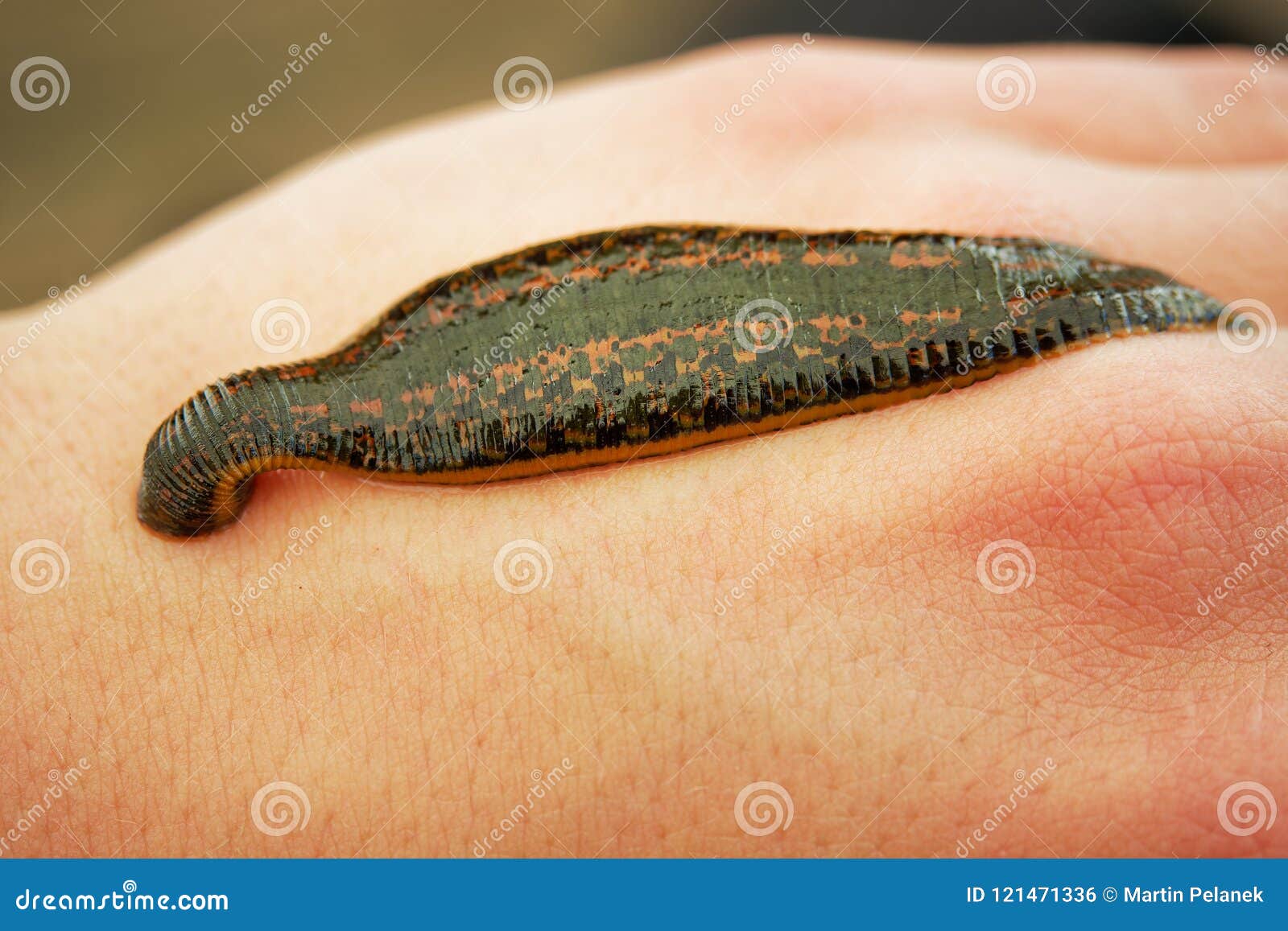 Medicinal Leech - Hirudo Medicinalis - Leech Bite, Leech is Sucking Blood  on the Human Body Hand Stock Photo - Image of illness, microbiology:  121471336