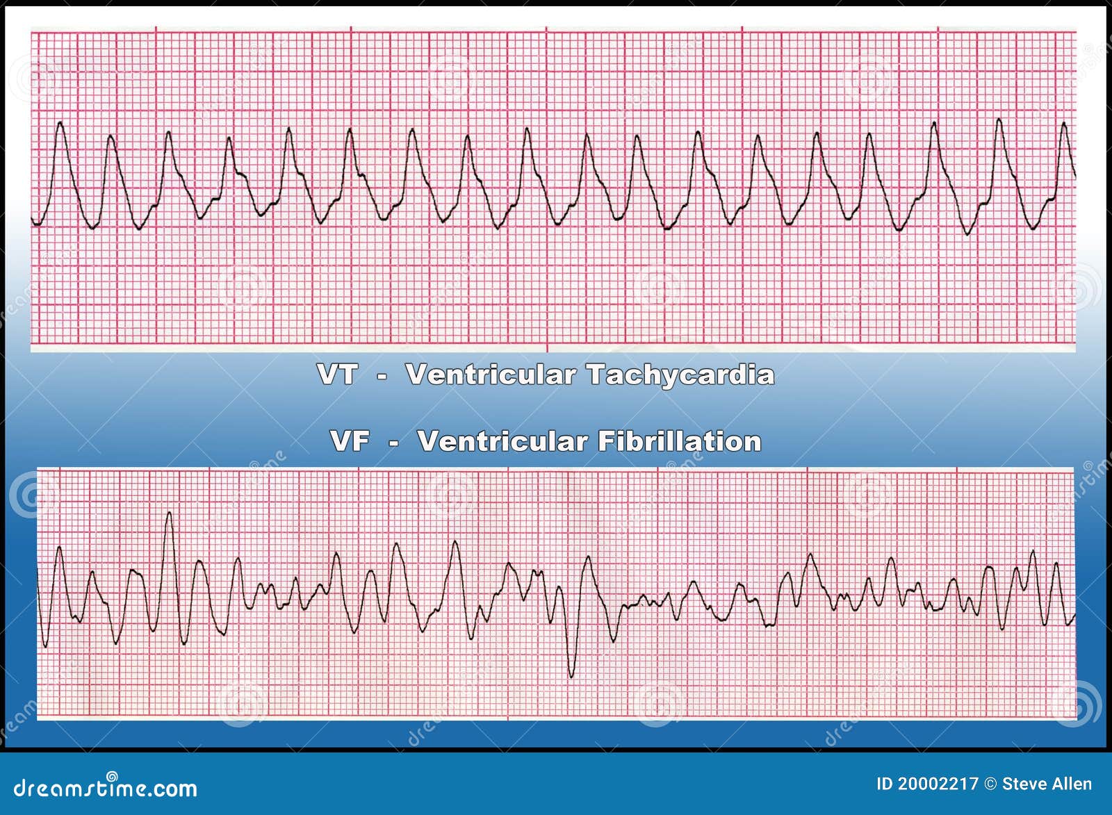 Medicine Deadly Heart Arrhythmia Vt Vf Stock Illustration Illustration Of Acute Beats