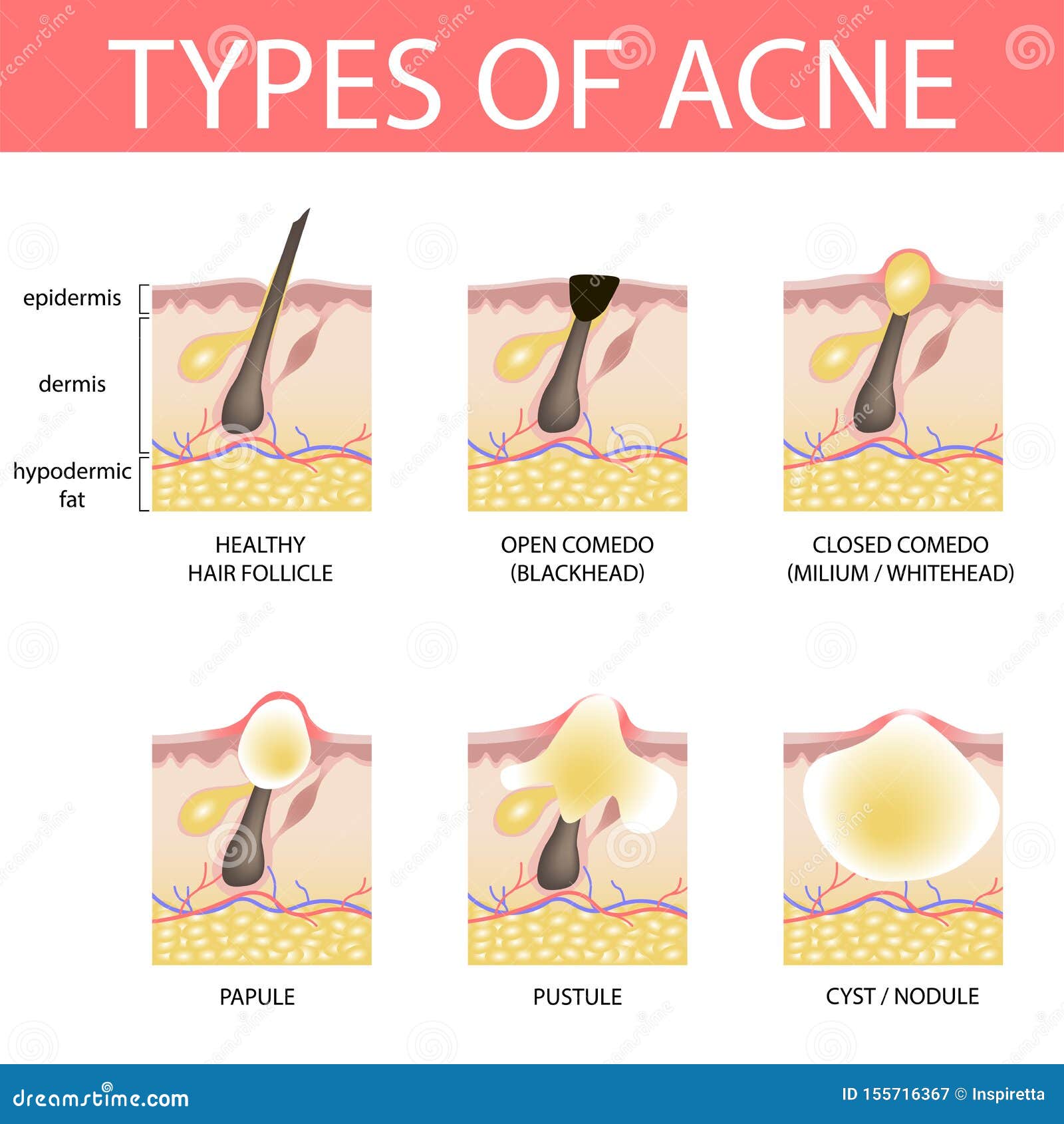 Medische Vectorillustratie Van Types Van Acne Op Menselijke Huid Verschijning Van Pukkels in Haarfollikel Vector Illustratie - Illustration of follikel, ontwerp: 155716367