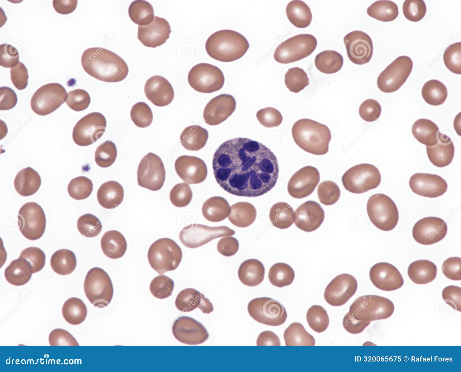 megaloblastic anemia. peripheral blood.