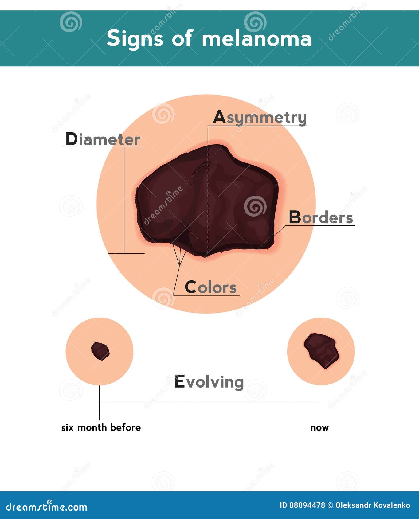 Melanoma Skin Cancer Diagram