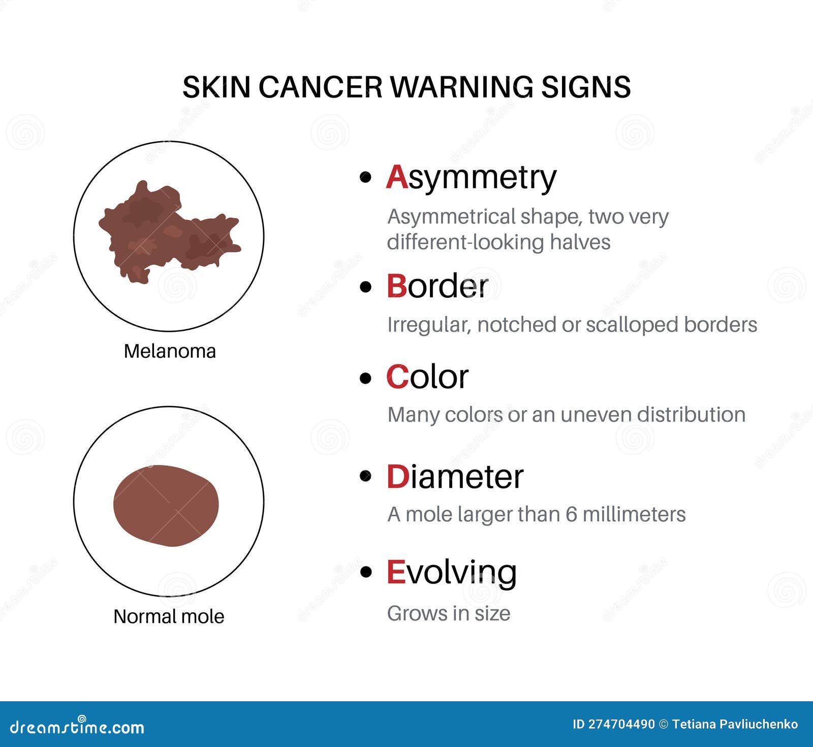 Melanoma warning signs stock vector. Illustration of tissue - 274704490