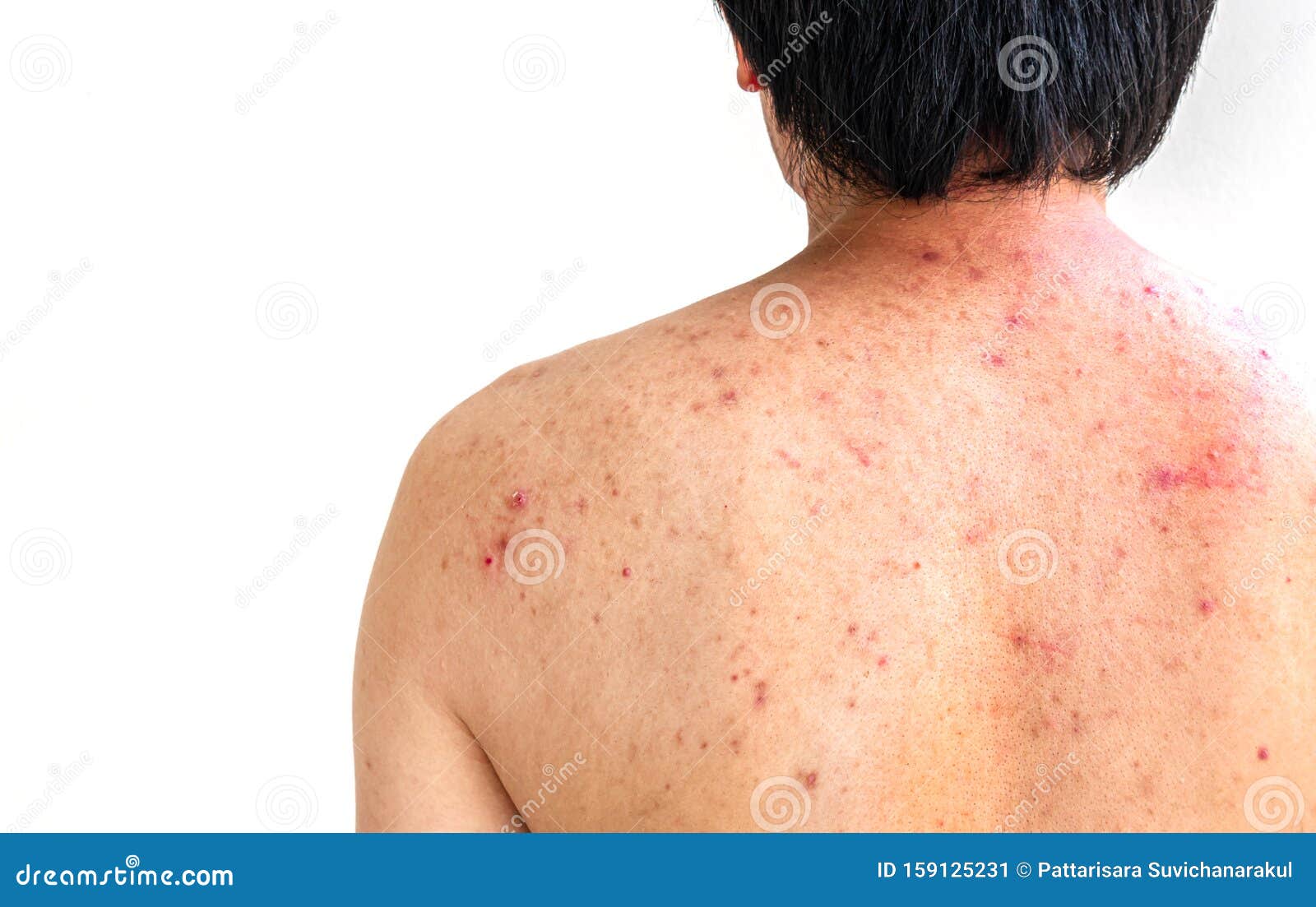 Men with Acne, with Red Spots on the Back Stock Image Image of
