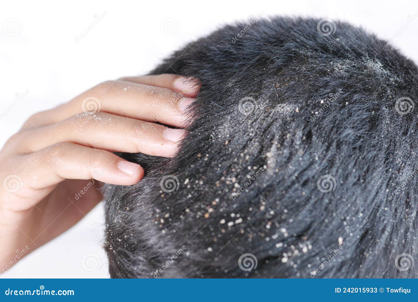 Men with Dandruff in His Hair, Closeup Stock Image Image of scaly