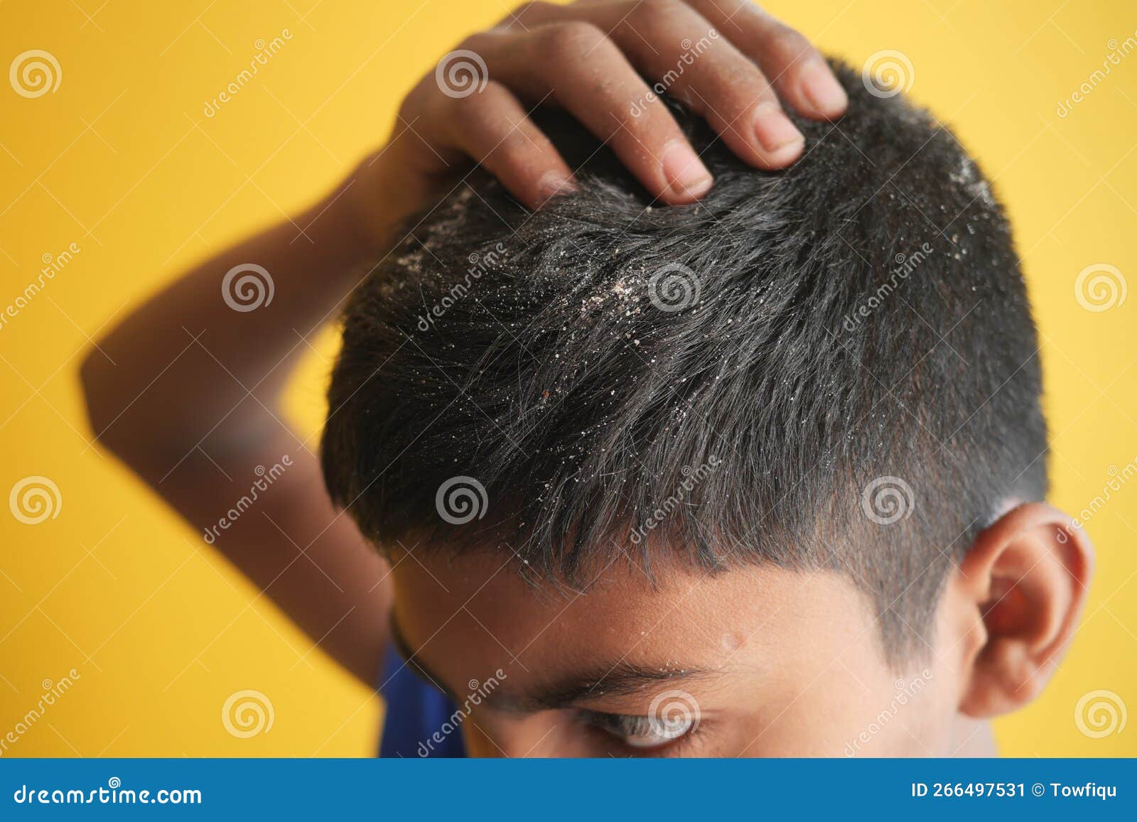 Men with Dandruff in His Hair, Closeup Stock Image Image of dandruff