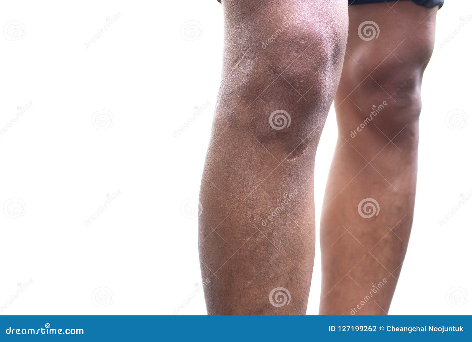 Men With Dry Skin Knees And Legs Area Stock Photo Image Of Knees