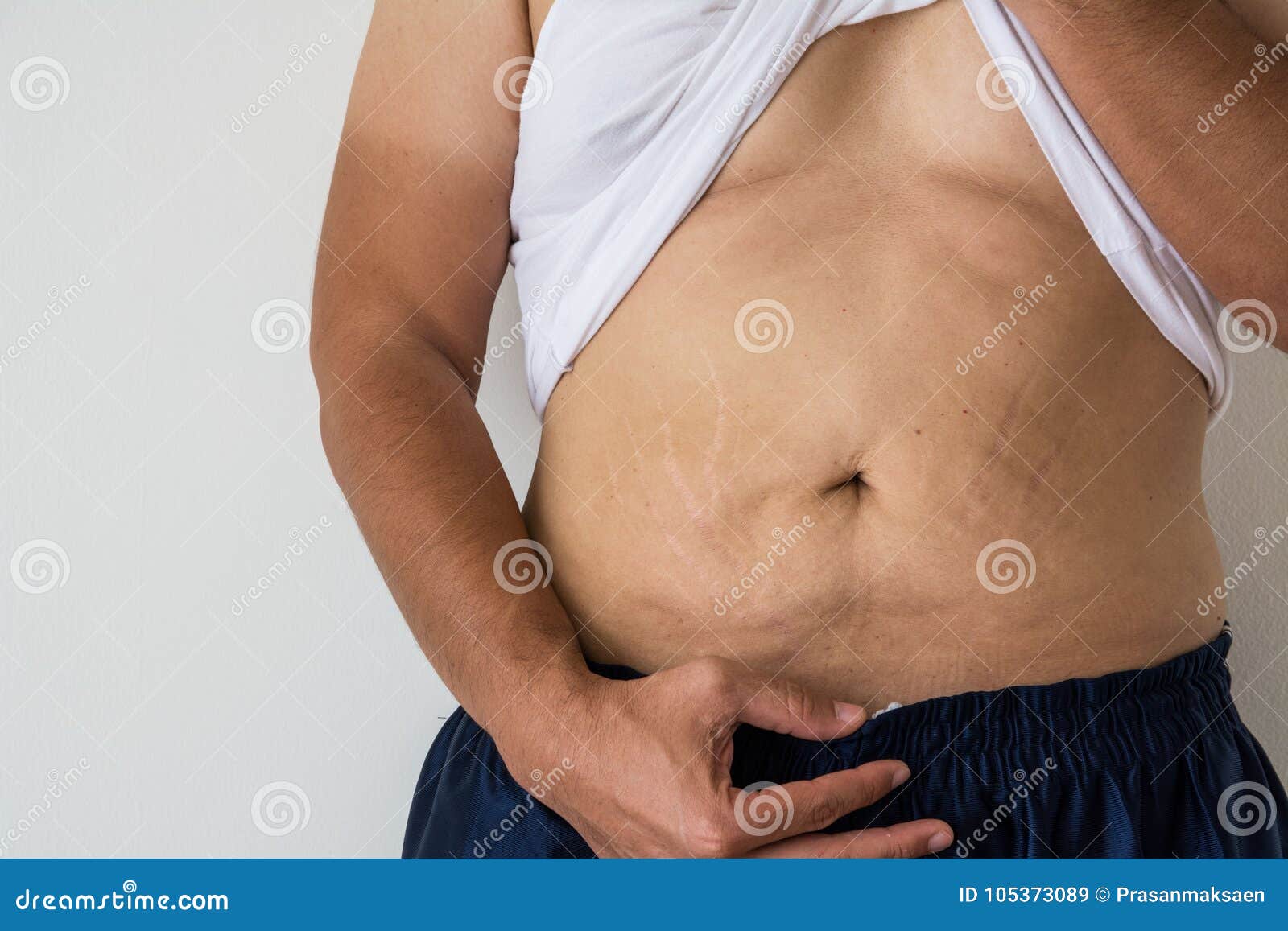 stretch marks on stomach stretch marks on stomach