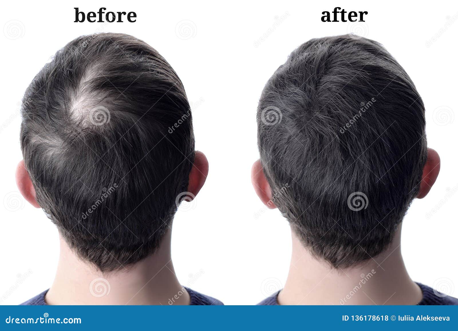 Men Hair after Using Cosmetic Powder Hair Thickening. before and after Stock Photo - Image of head, emptiness: 136178618 Men Hair after Using Cosmetic Powder Hair Thickening. before and after Stock Photo - Image of head, emptiness: 136178618