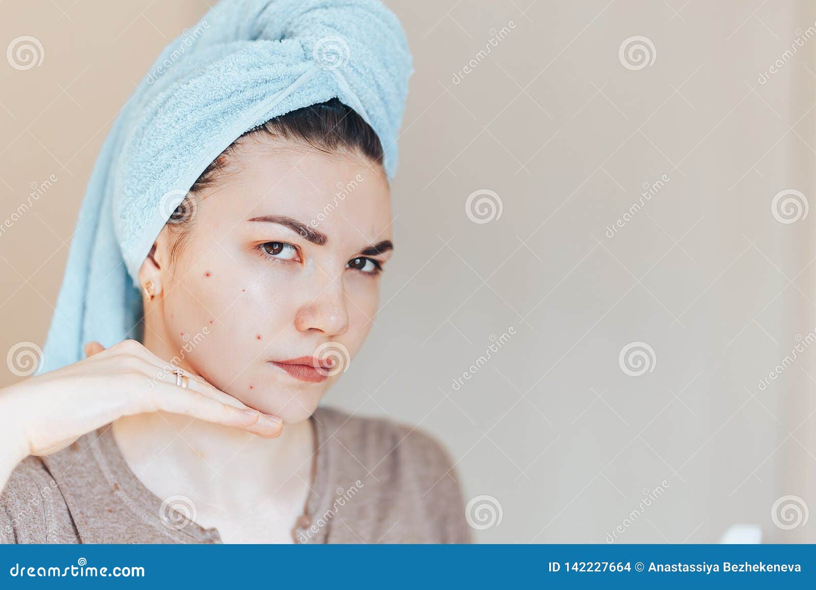 Menina De Scowling Que Aponta Para Sua Acne Com Uma Toalha Em Sua Cabeça.  Conceito Do Cuidado Da Pele Da Mulher, Fotos Da Menina Feia Da Pele Do  Problema No Fundo Branco