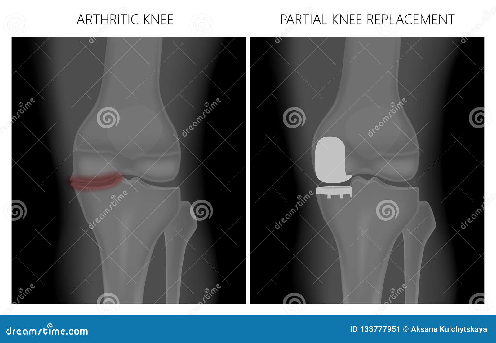 Meniscus _Arthritic Knee and Partial Knee Replacement Stock Vector