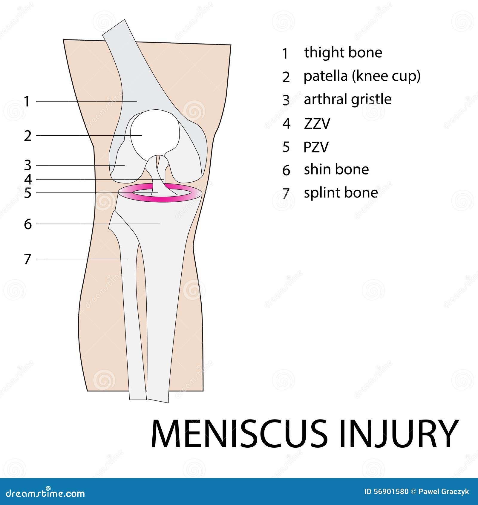 Meniscus knee injury stock vector. Illustration of runner 56901580