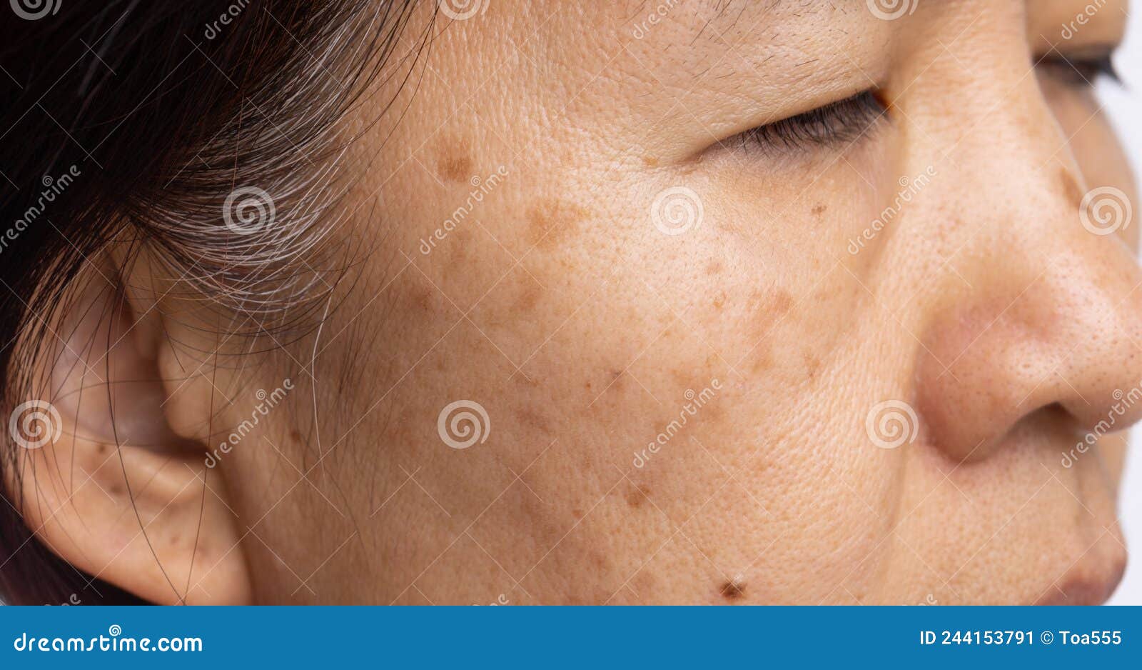 Menopausal Women Worry about Melasma on Face Stock Image Image of