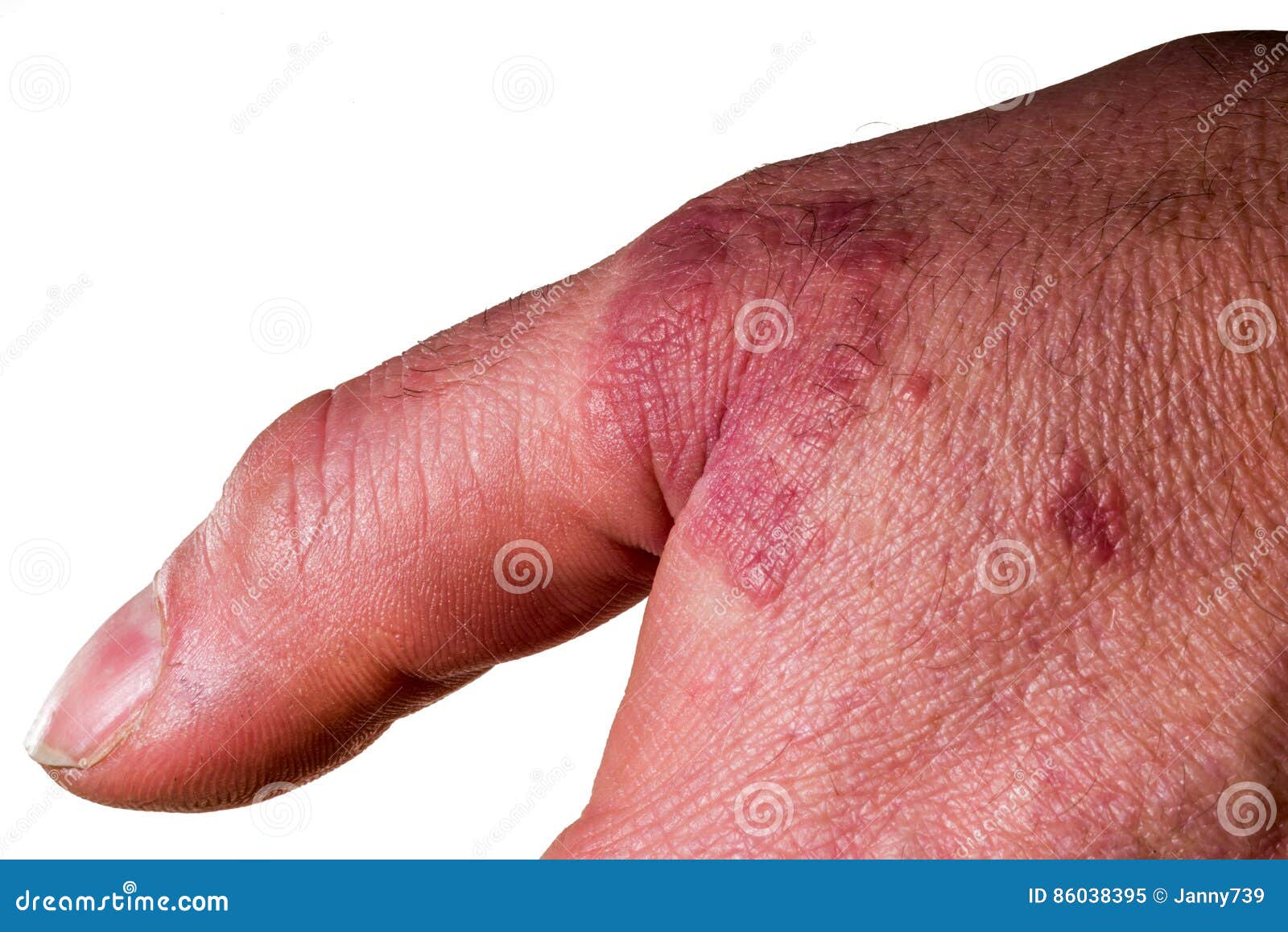 Menschliche Hand Mit Hautausschlag/Ekzem Stockbild Bild von haut