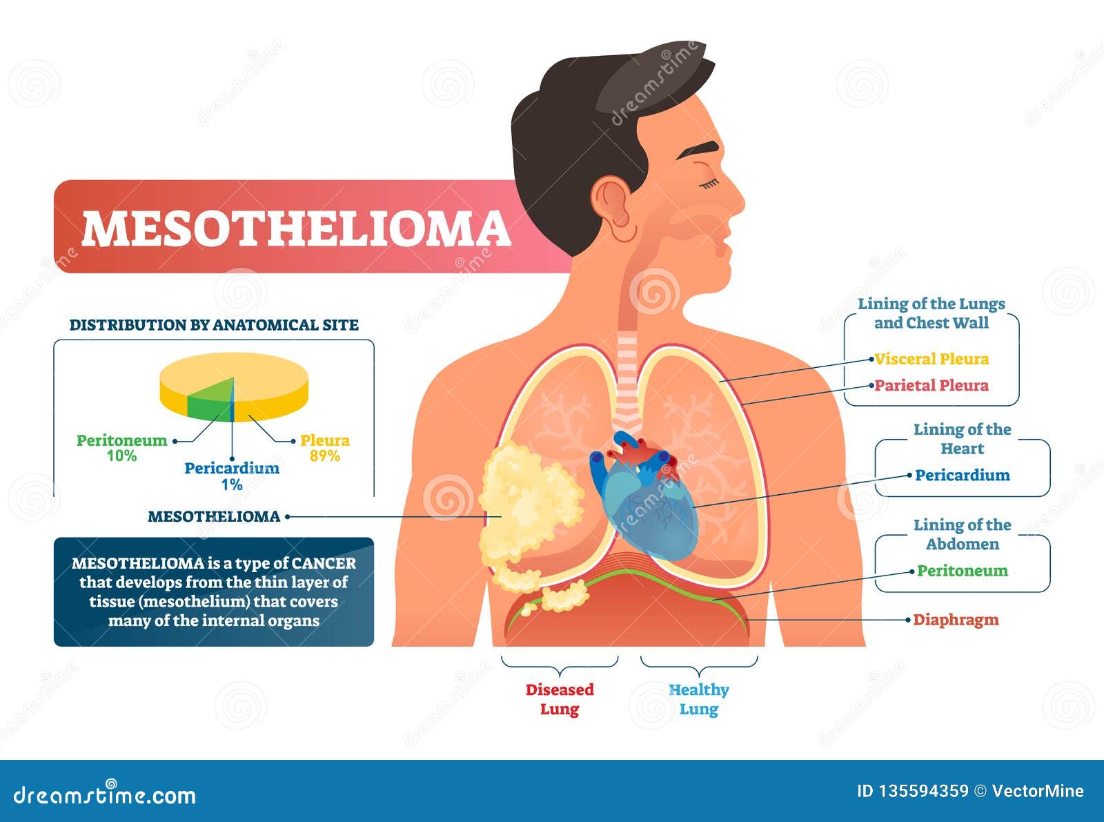 mesothelioma cure close