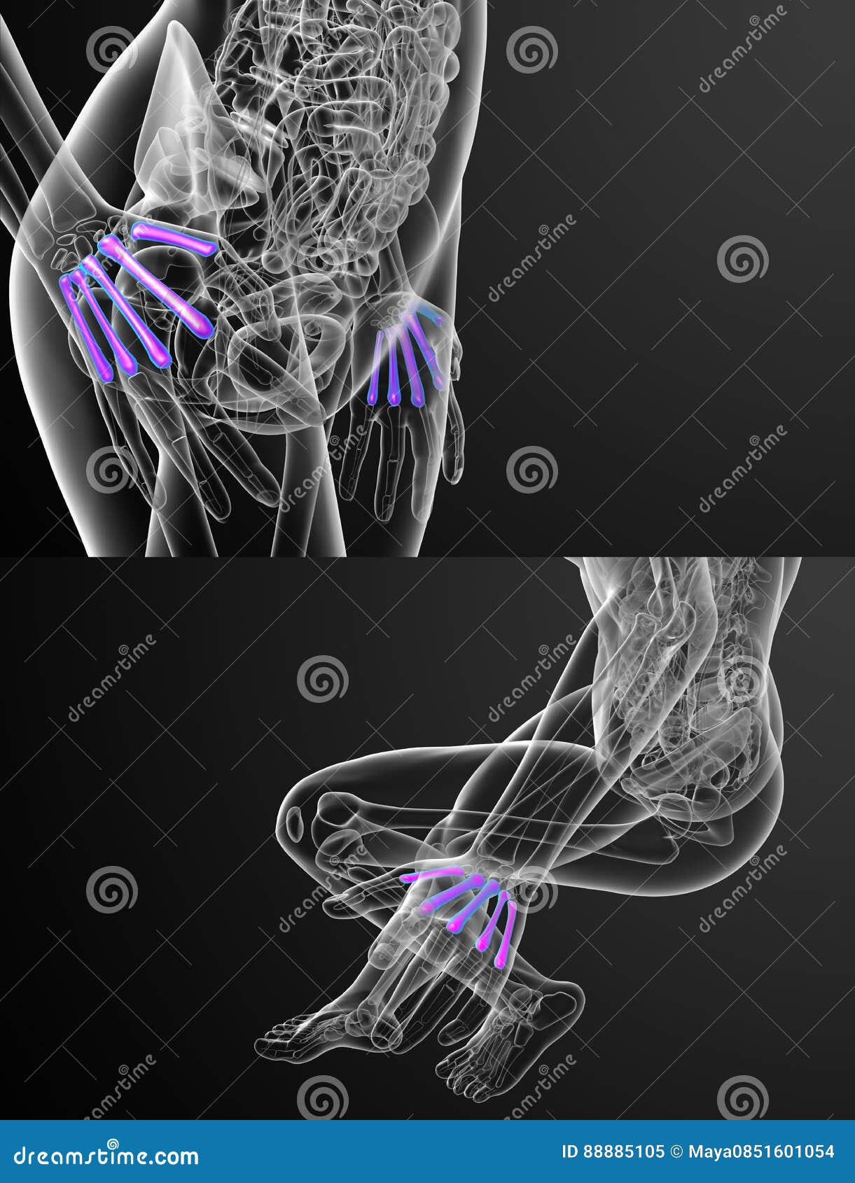 metacarpal bone