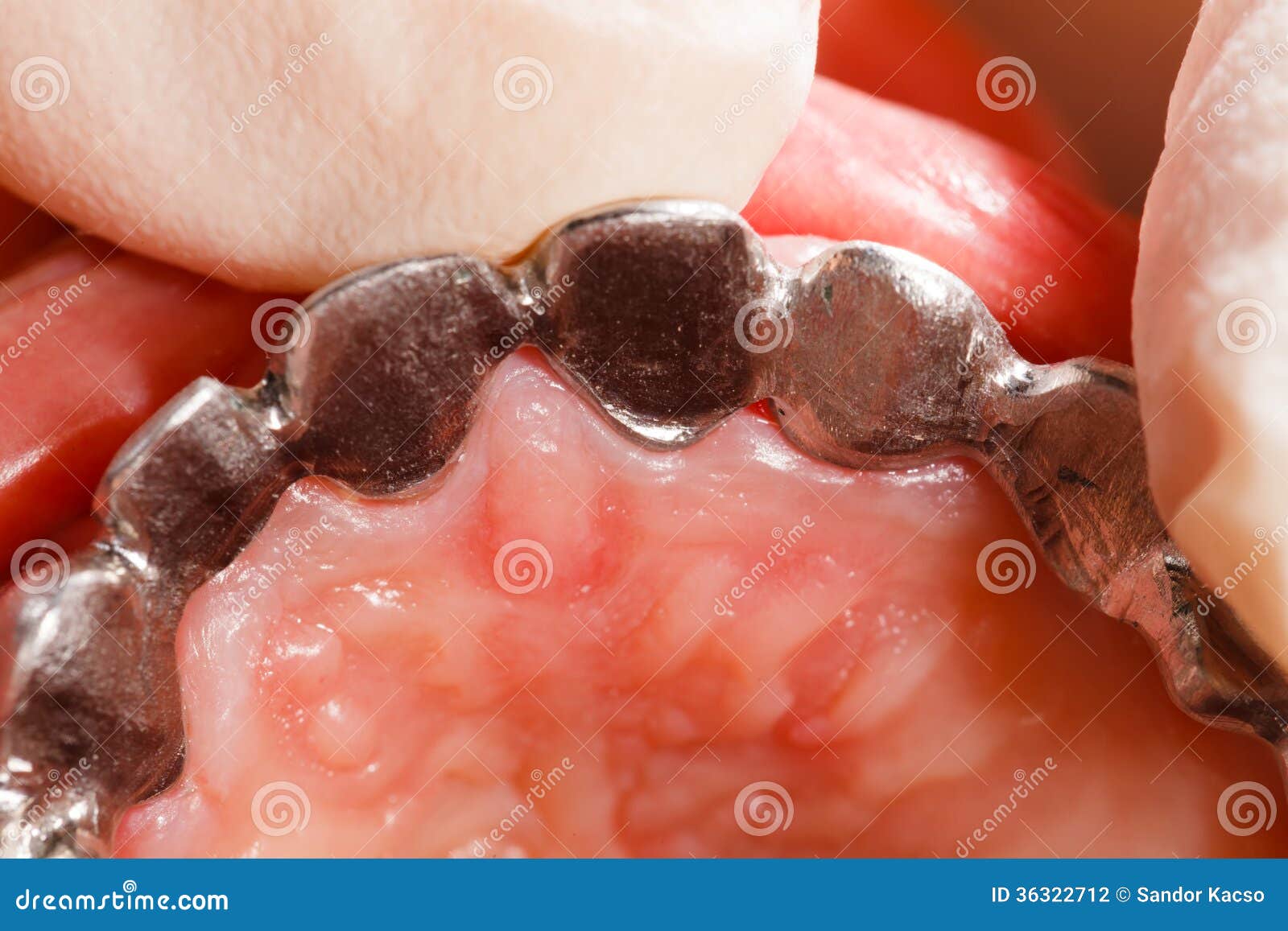 Metal Basis Dental Bridge stock photo. Image of bridges 36322712