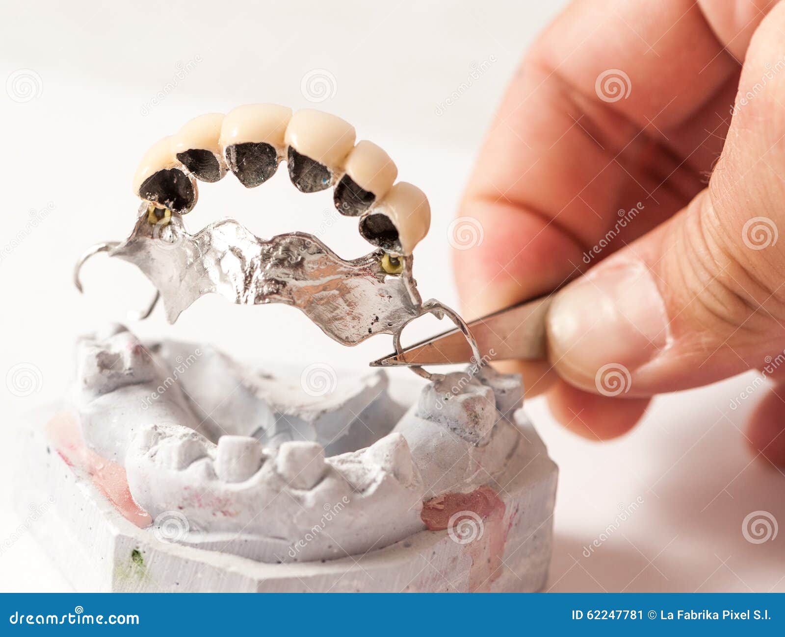 Metal Ceramic Bridge stock image. Image of orthodontal 62247781