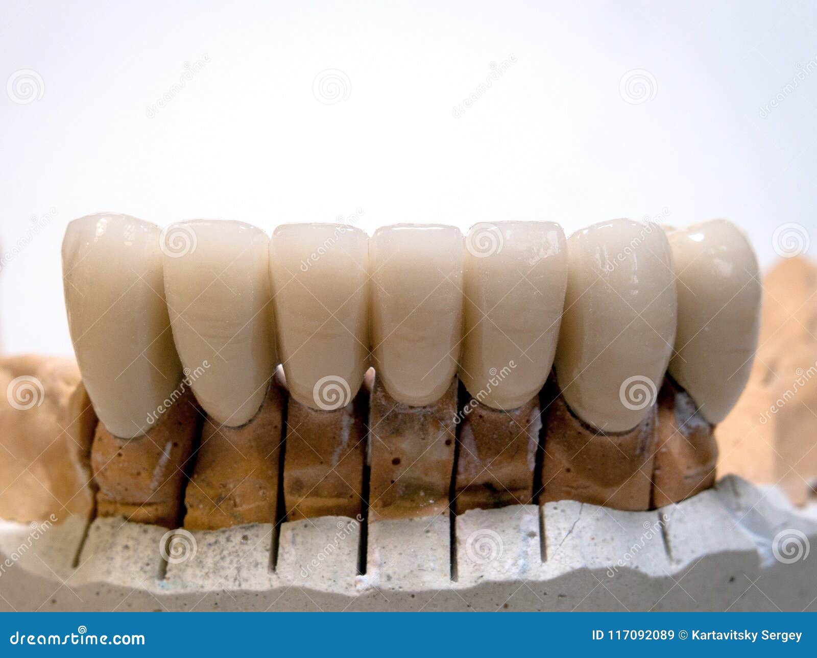 Metal Ceramic Bridge Tooth Unit RoyaltyFree Stock Photography