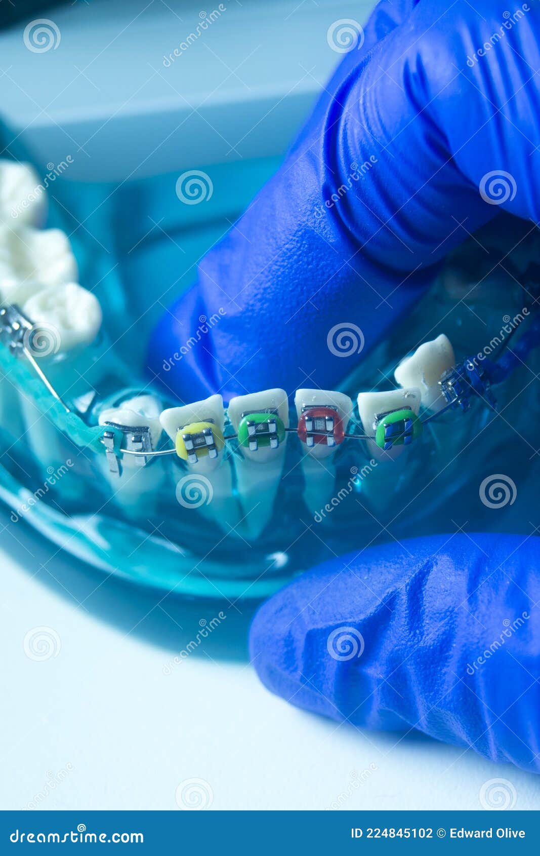 Metal teeth brackets stock photo. Image of brackets 224845102